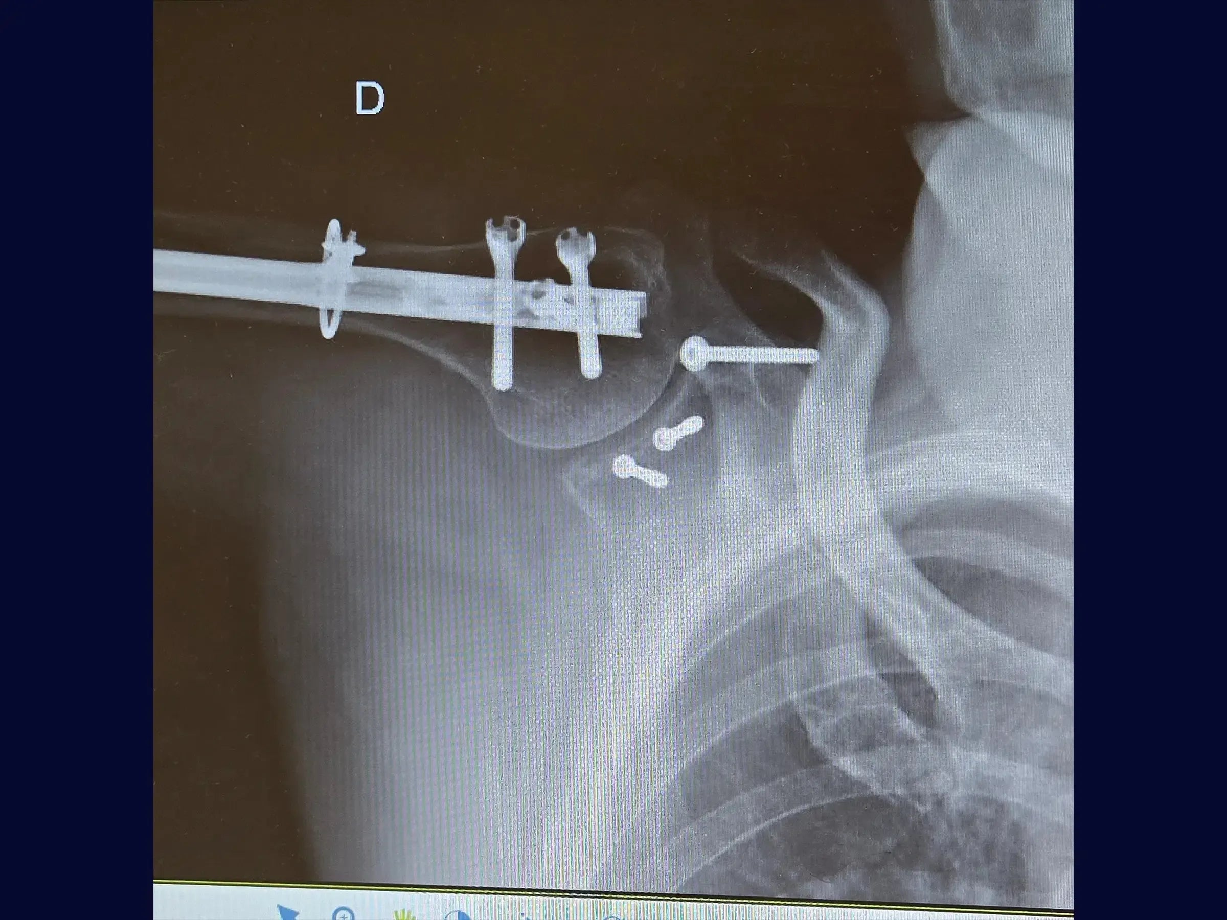 Segmental Humeral Fracture Associated with Glenoid and Coracoid Process Fractures