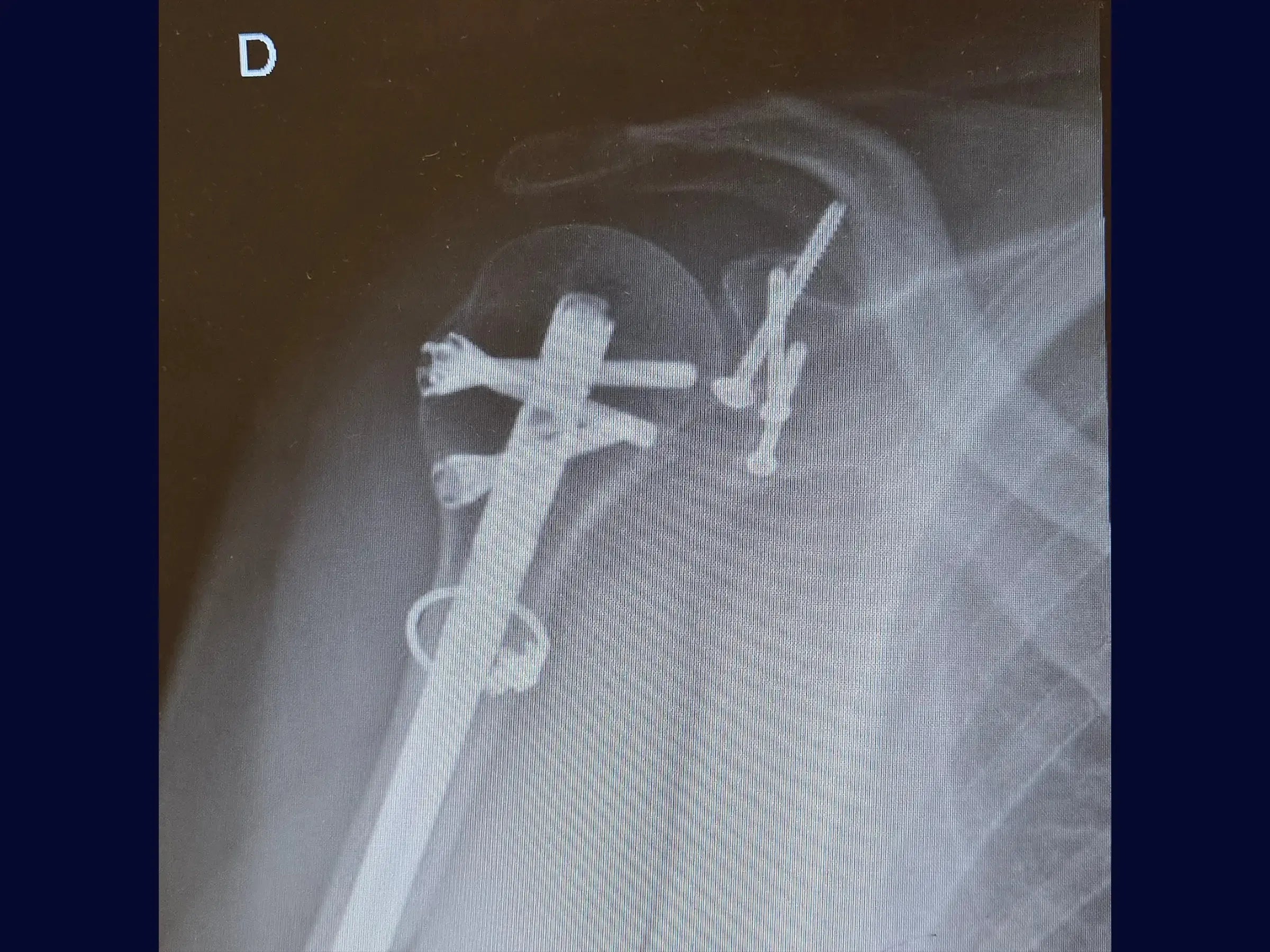 Segmental Humeral Fracture Associated with Glenoid and Coracoid Process Fractures