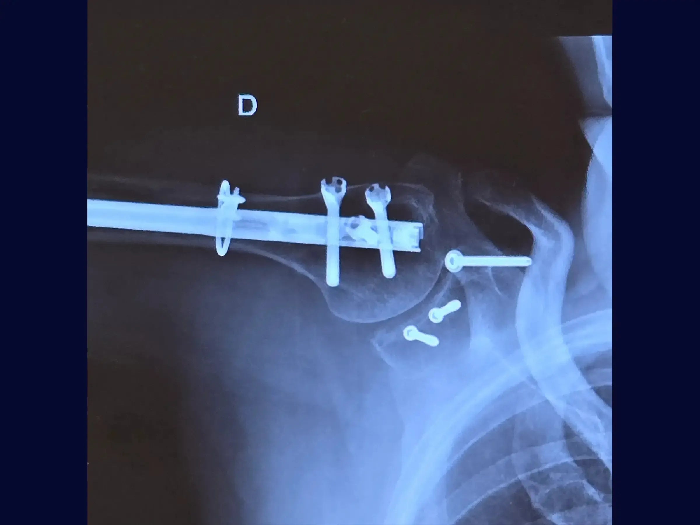 Segmental Humeral Fracture Associated with Glenoid and Coracoid Process Fractures