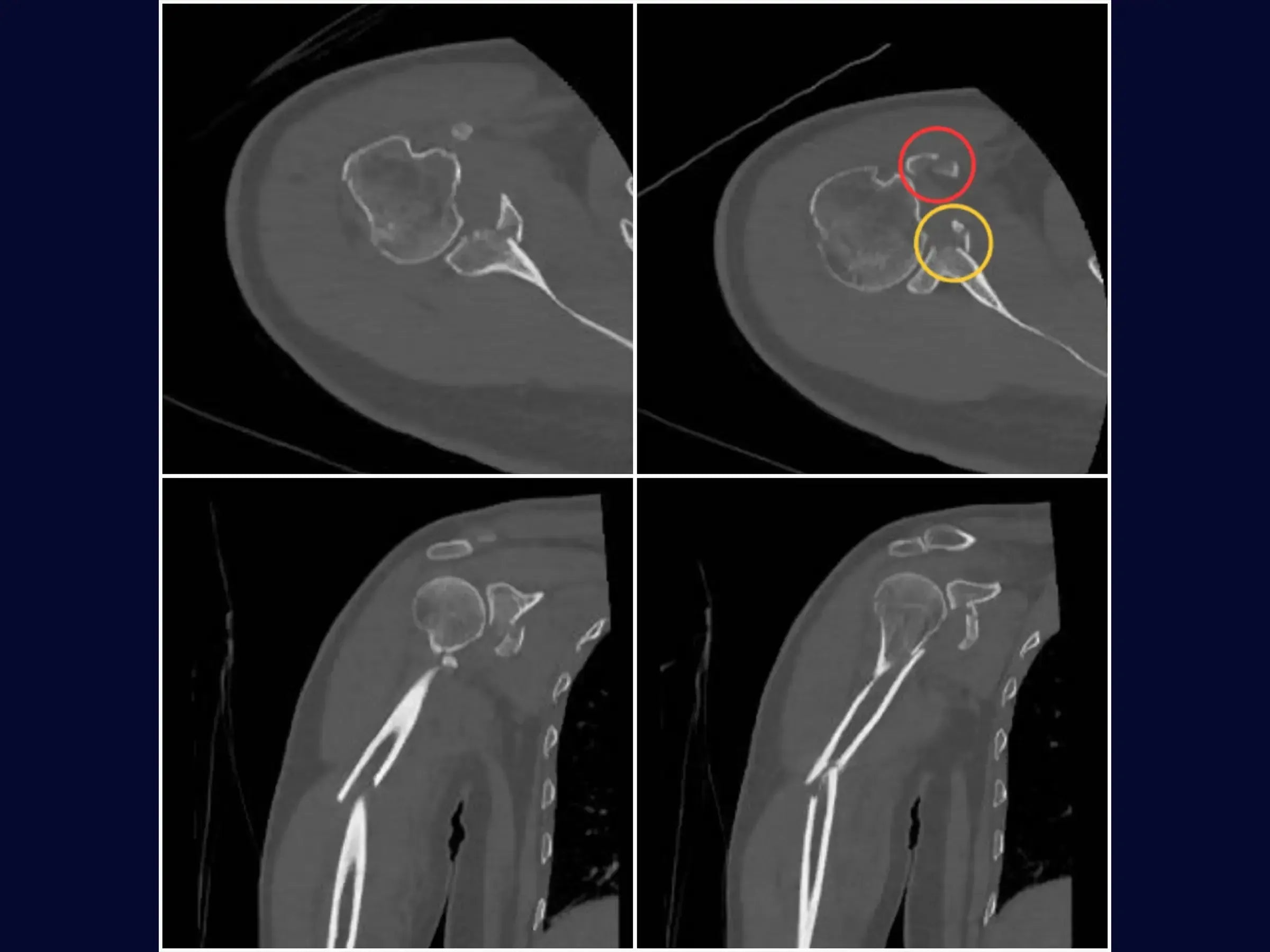 Segmental Humeral Fracture Associated with Glenoid and Coracoid Process Fractures