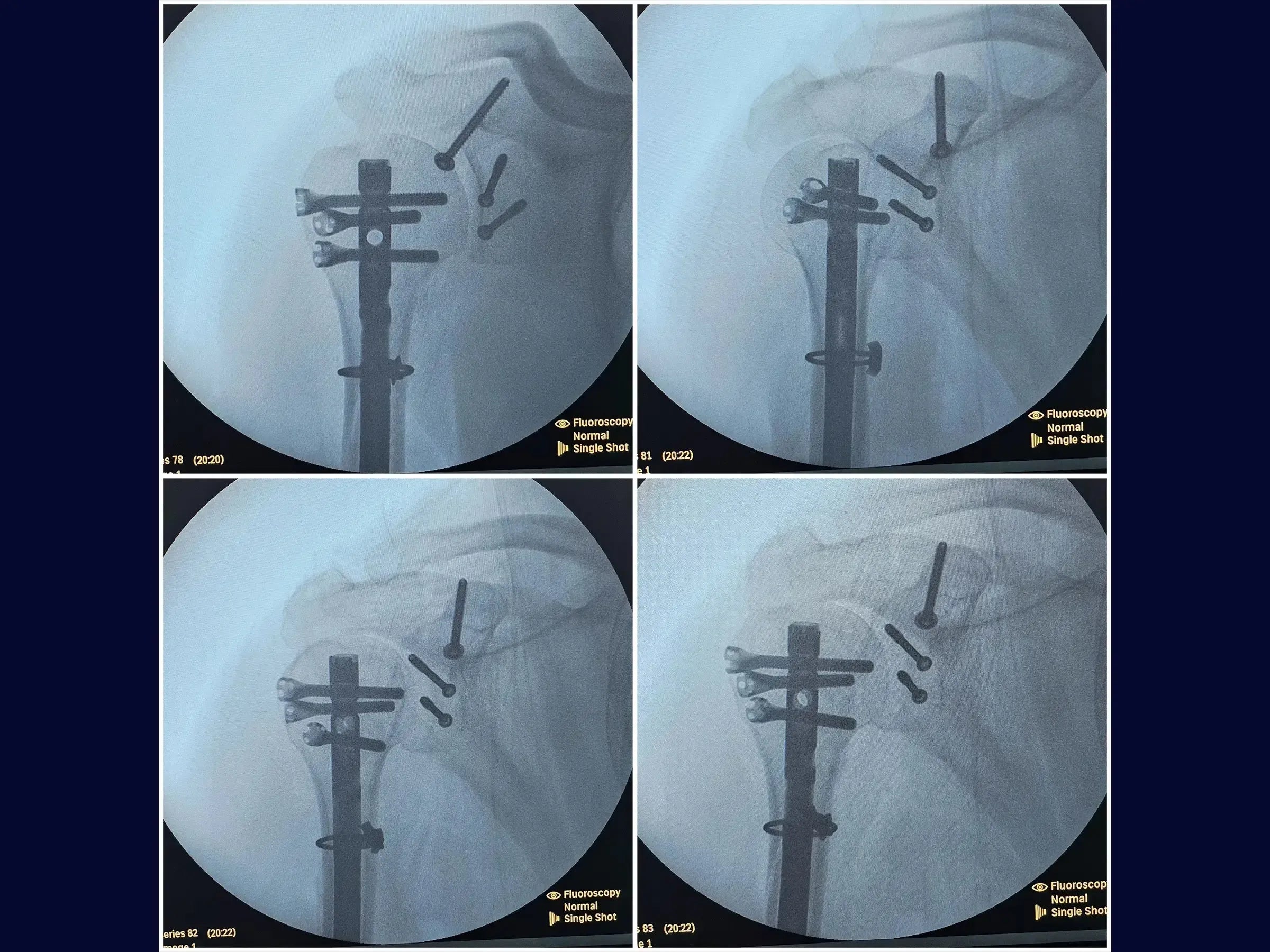 Segmental Humeral Fracture Associated with Glenoid and Coracoid Process Fractures