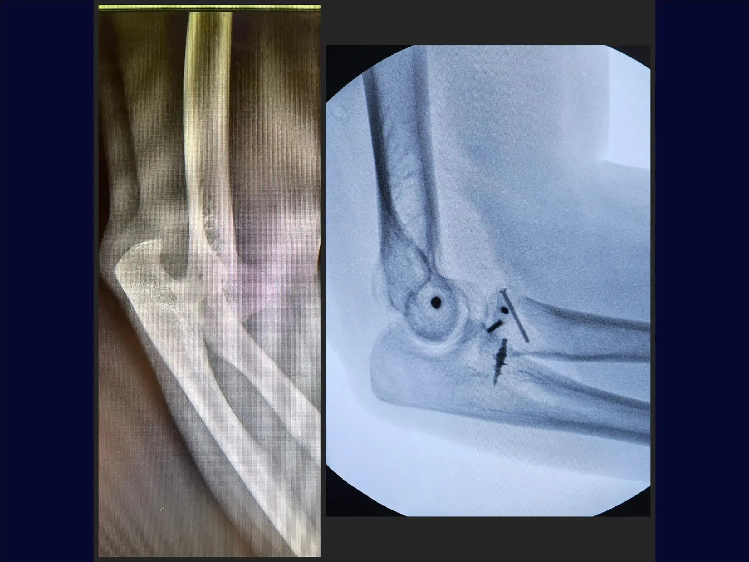 Terrible Triad of the Elbow