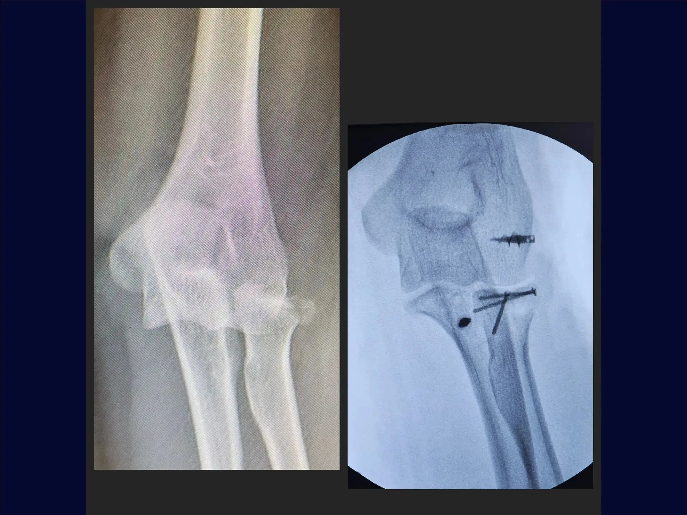Terrible Triad of the Elbow