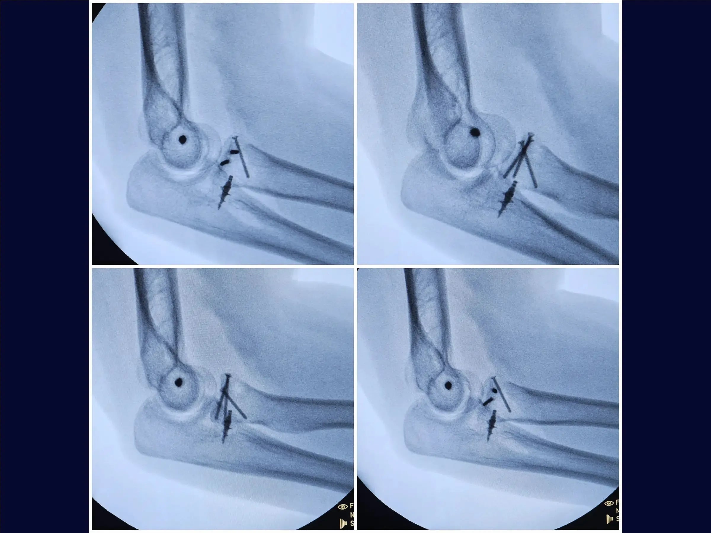 Terrible Triad of the Elbow