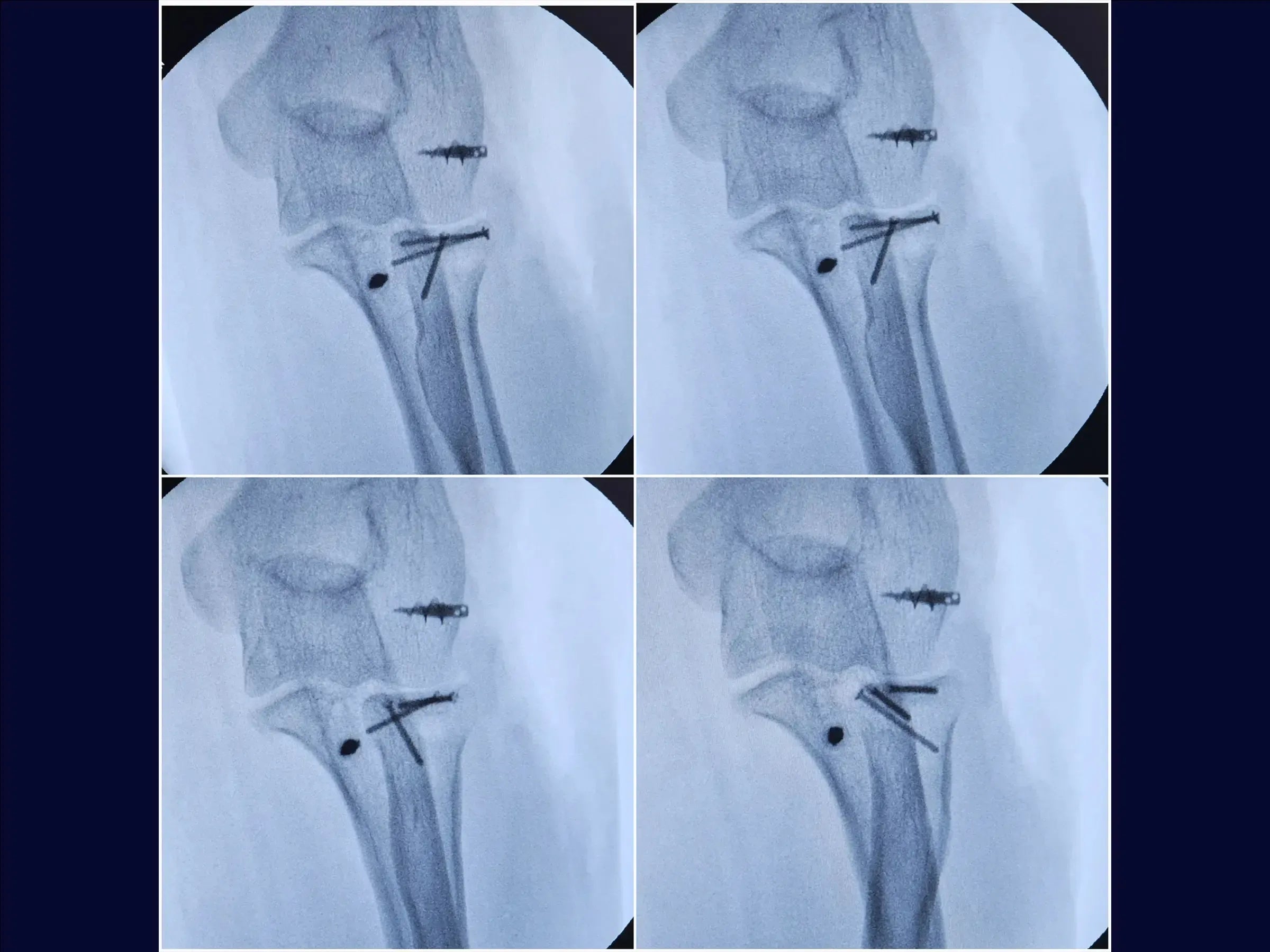 Terrible Triad of the Elbow