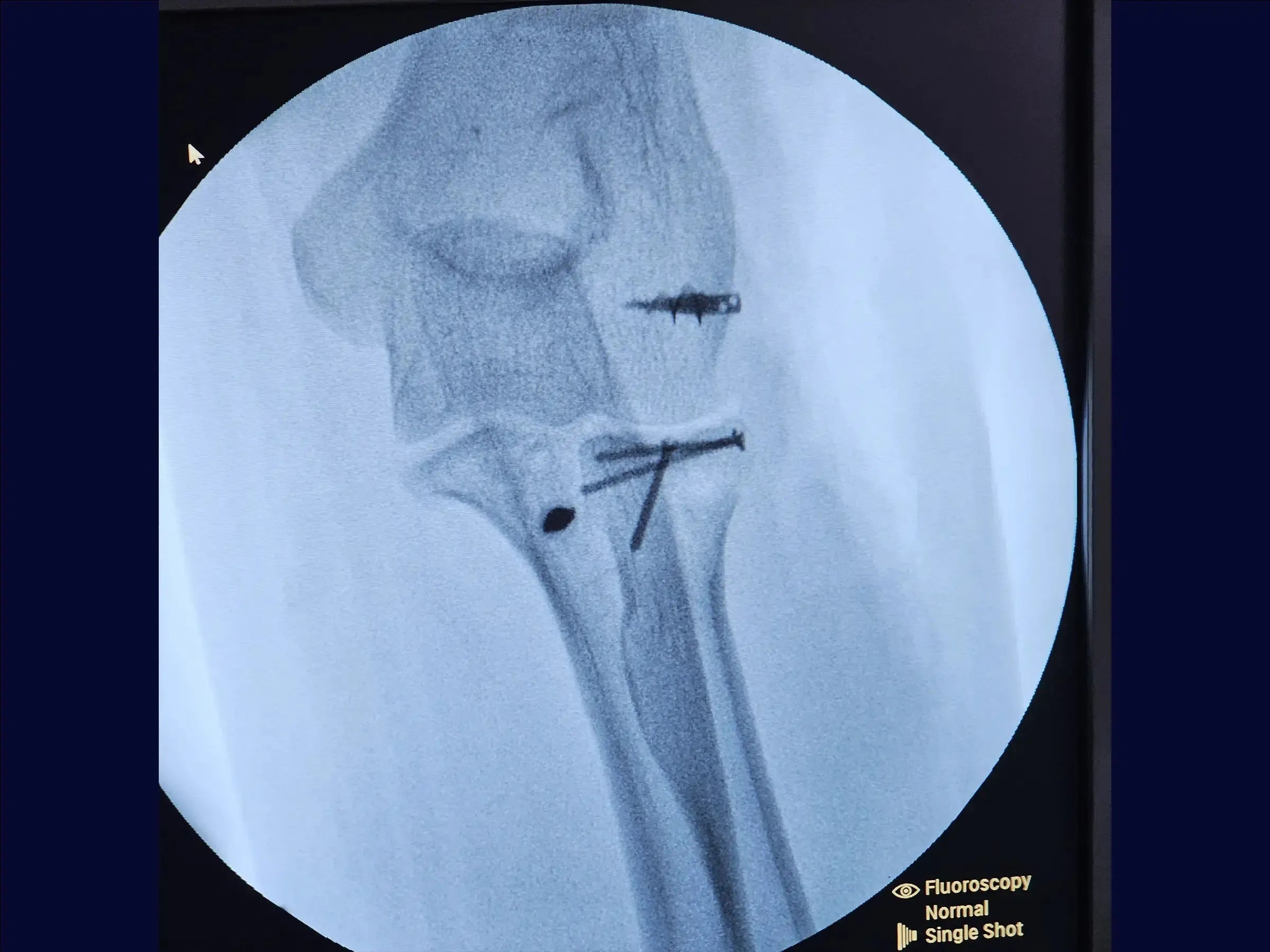 Terrible Triad of the Elbow