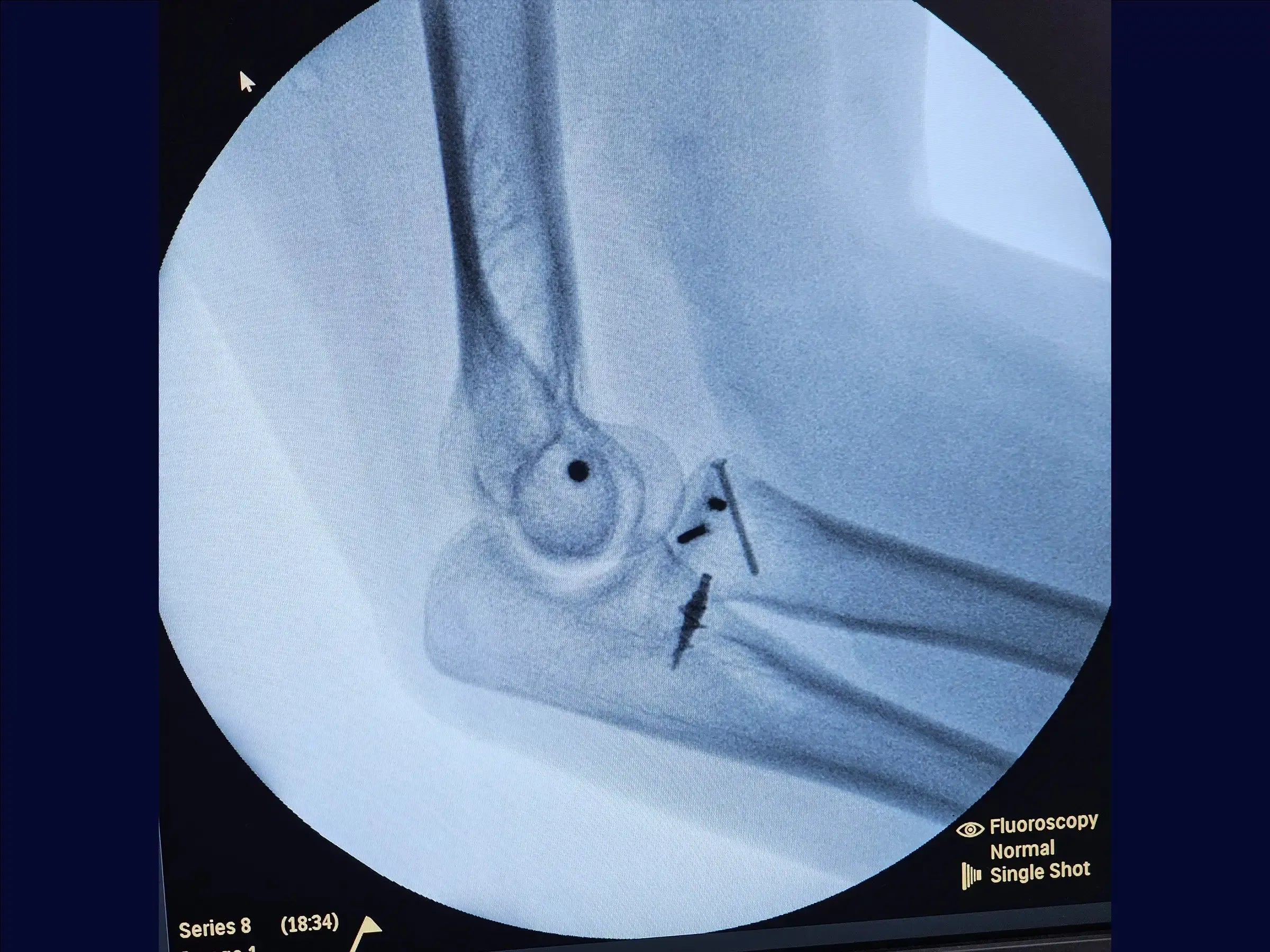 Terrible Triad of the Elbow