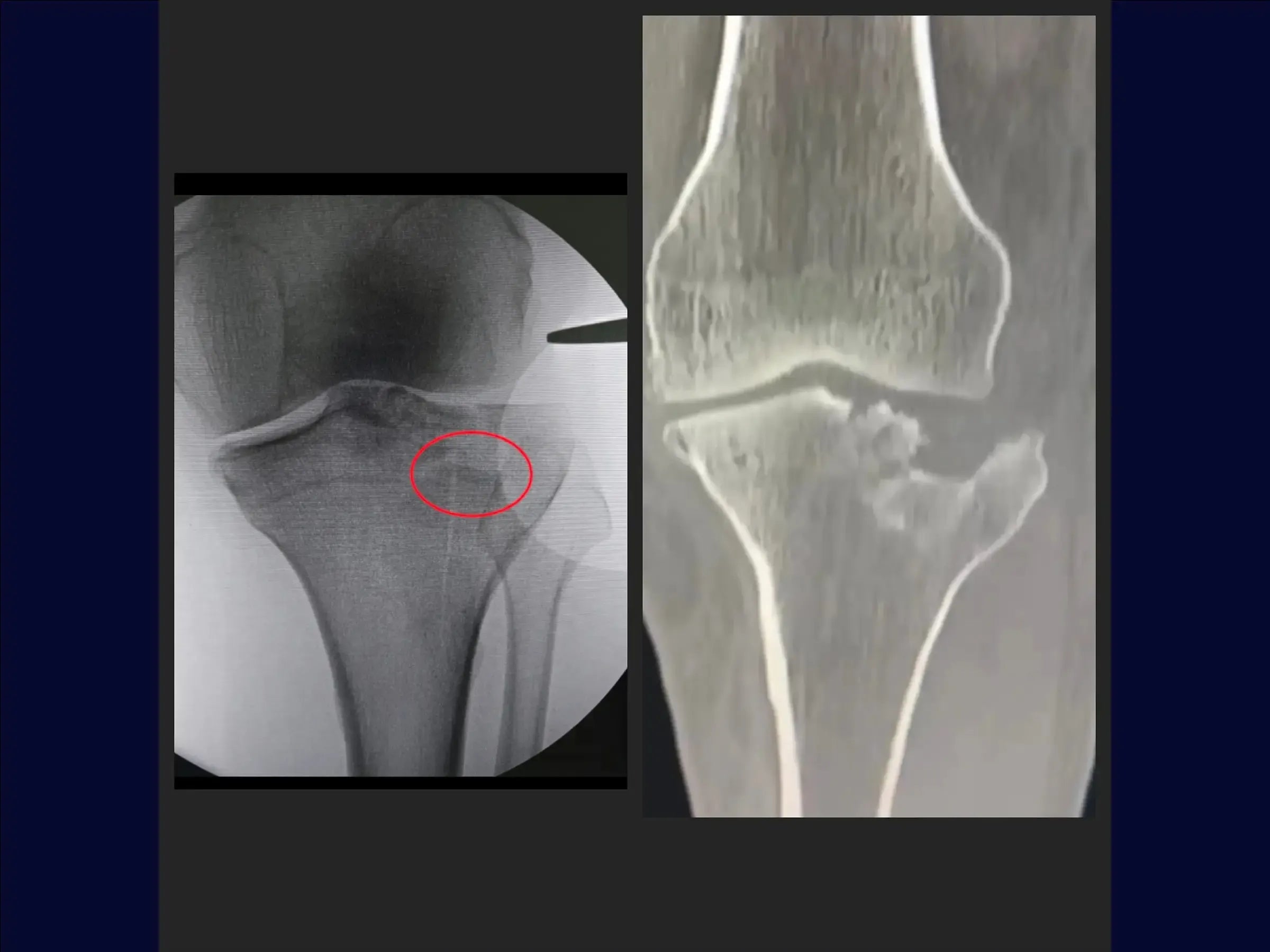 Tibial Plateau Fracture with Central Depression (Anterolateral Approach and Incomplete Osteotomy)