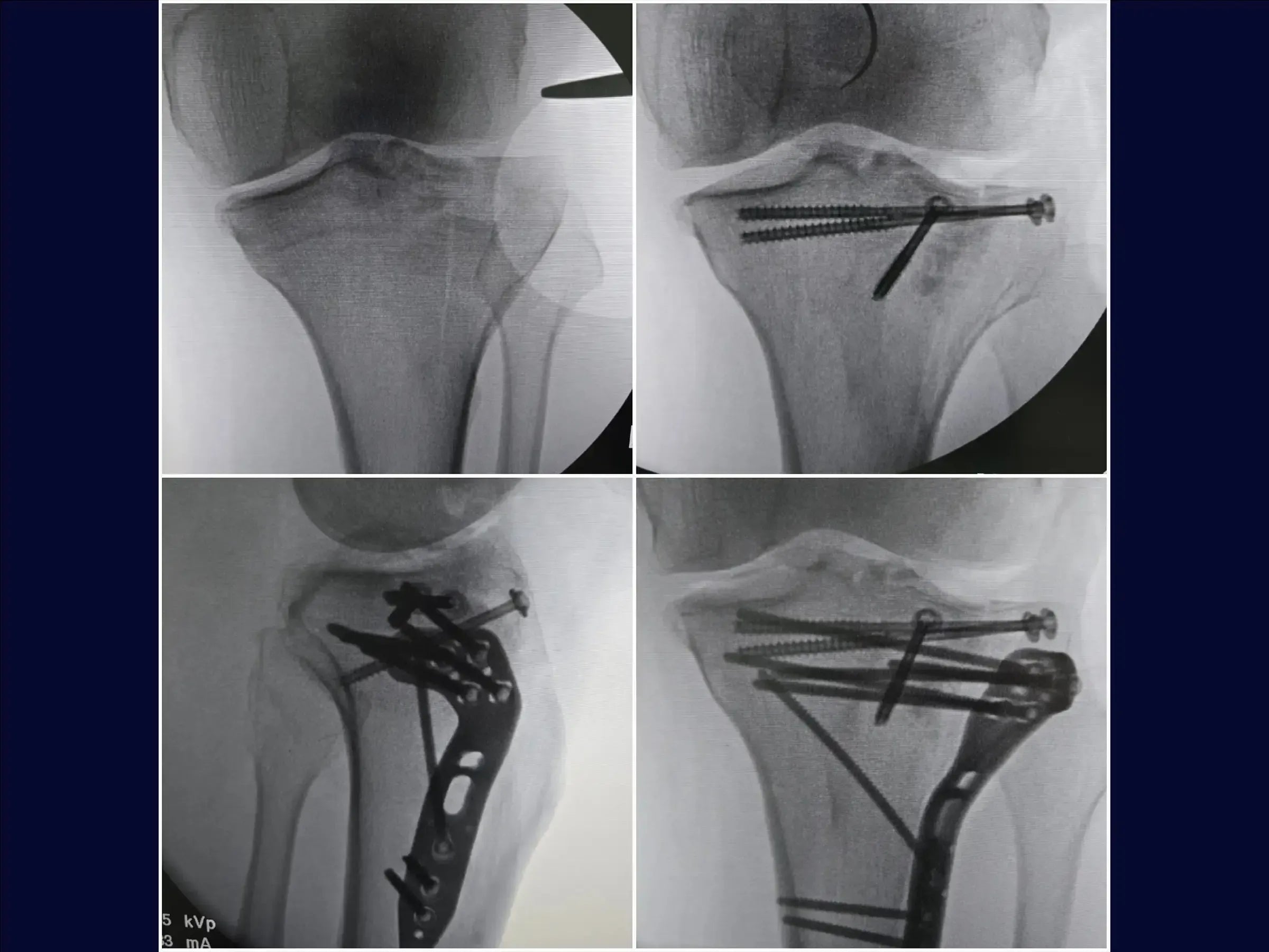 Tibial Plateau Fracture with Central Depression (Anterolateral Approach and Incomplete Osteotomy)