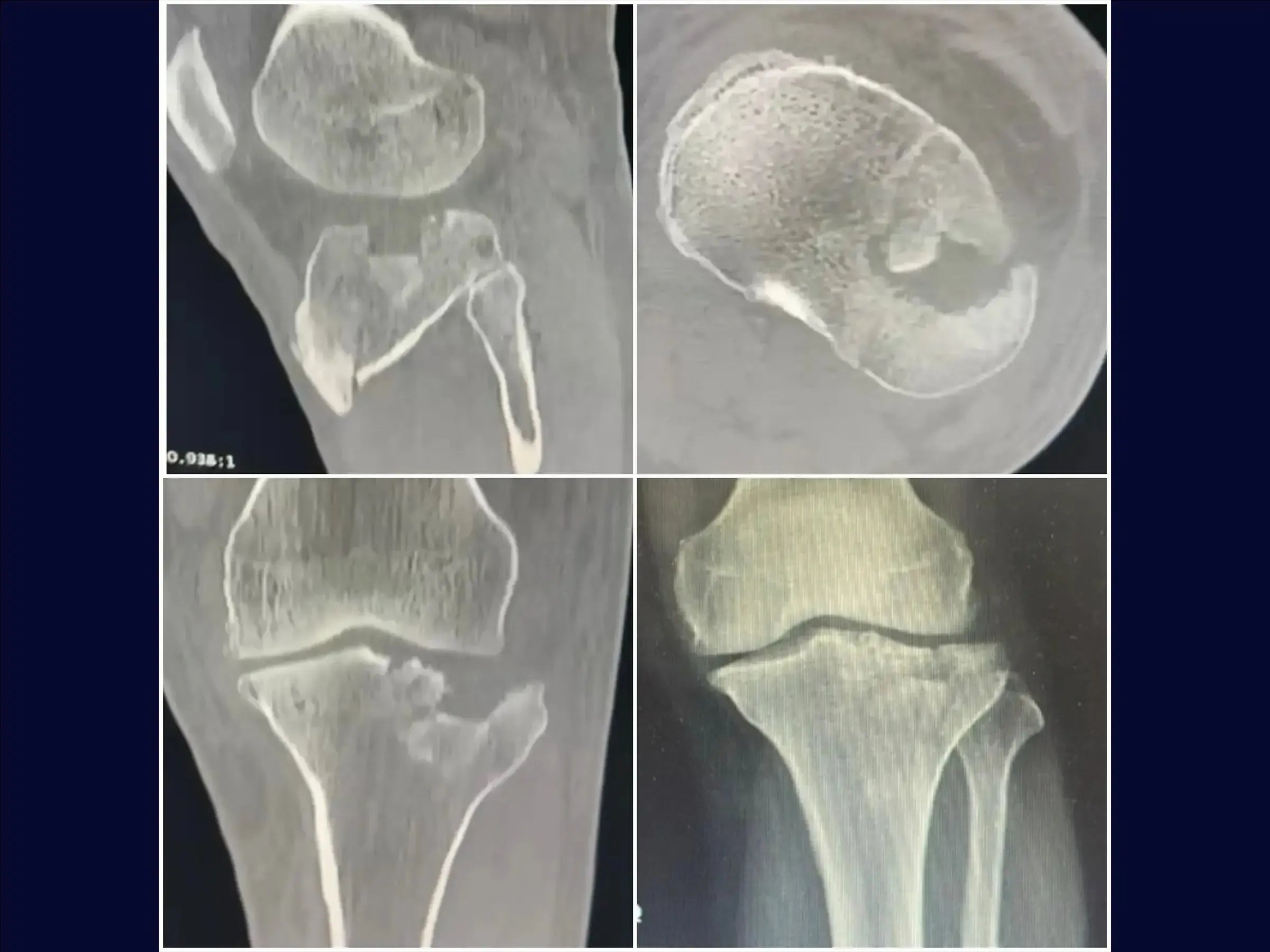Tibial Plateau Fracture with Central Depression (Anterolateral Approach and Incomplete Osteotomy)