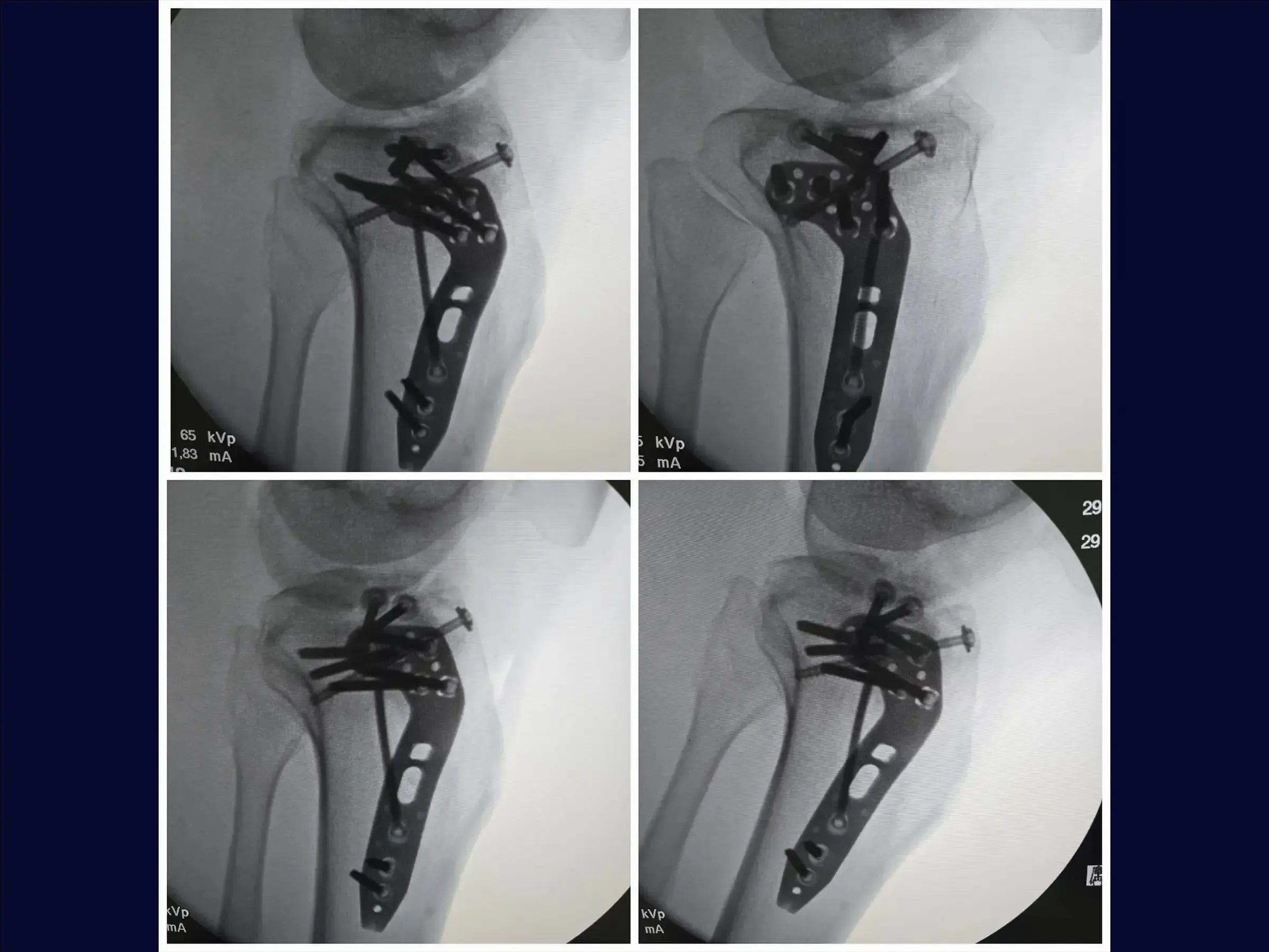 Tibial Plateau Fracture with Central Depression (Anterolateral Approach and Incomplete Osteotomy)