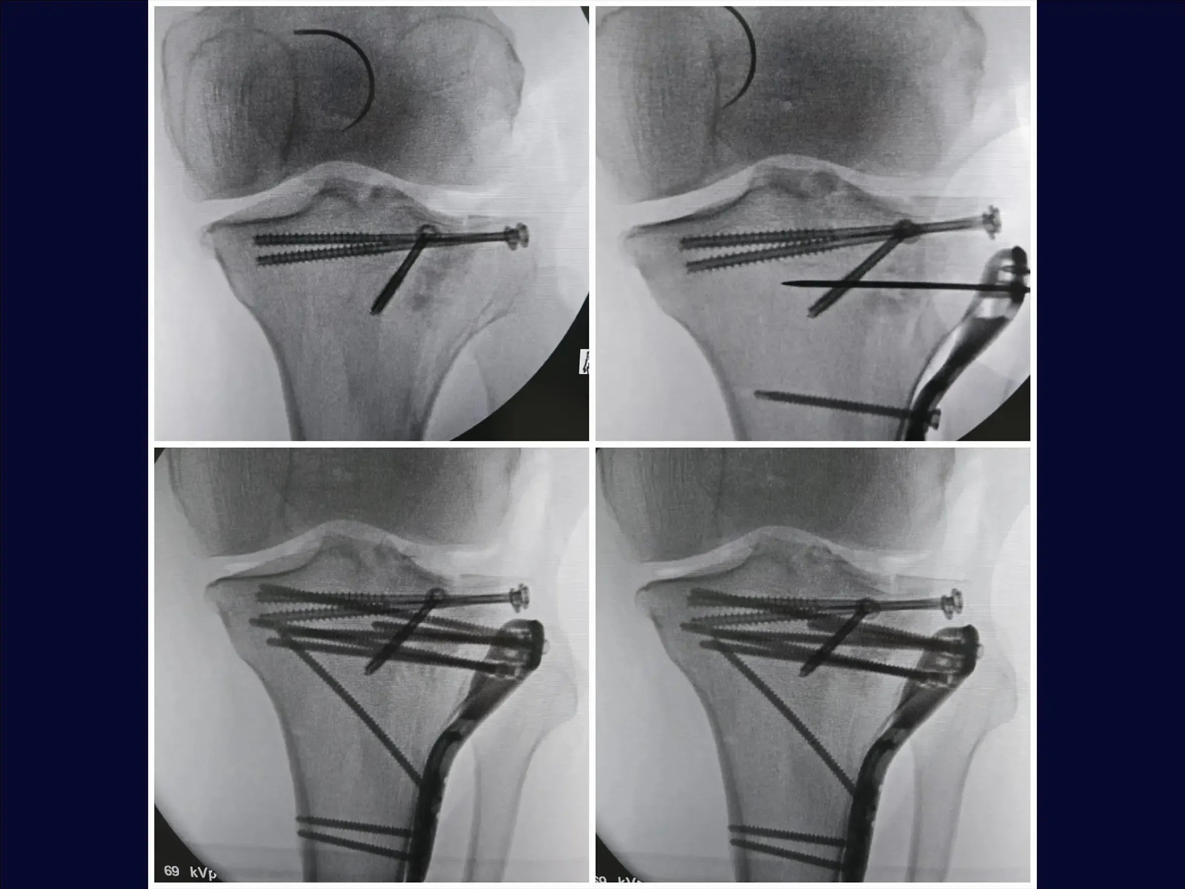 Tibial Plateau Fracture with Central Depression (Anterolateral Approach and Incomplete Osteotomy)