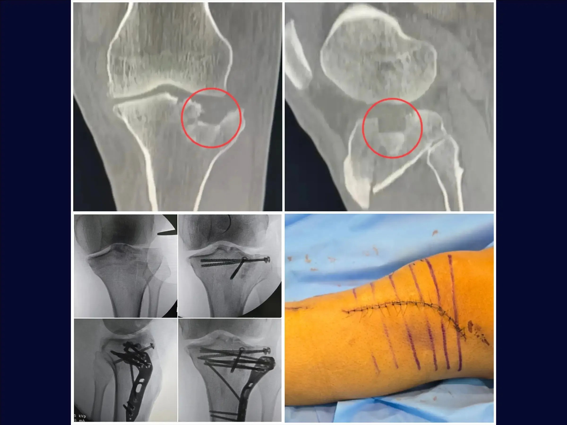 Tibial Plateau Fracture with Central Depression (Anterolateral Approach and Incomplete Osteotomy)