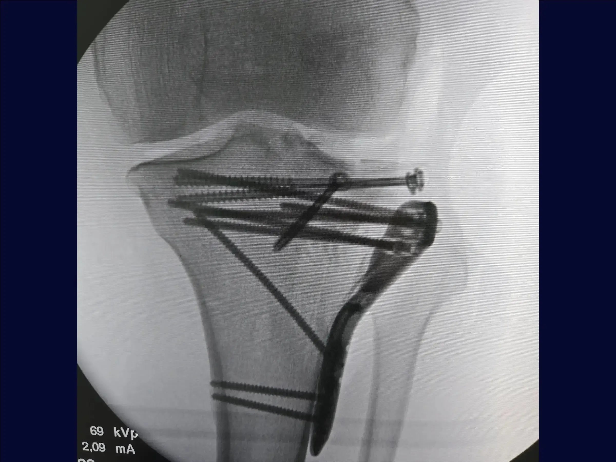 Tibial Plateau Fracture with Central Depression (Anterolateral Approach and Incomplete Osteotomy)