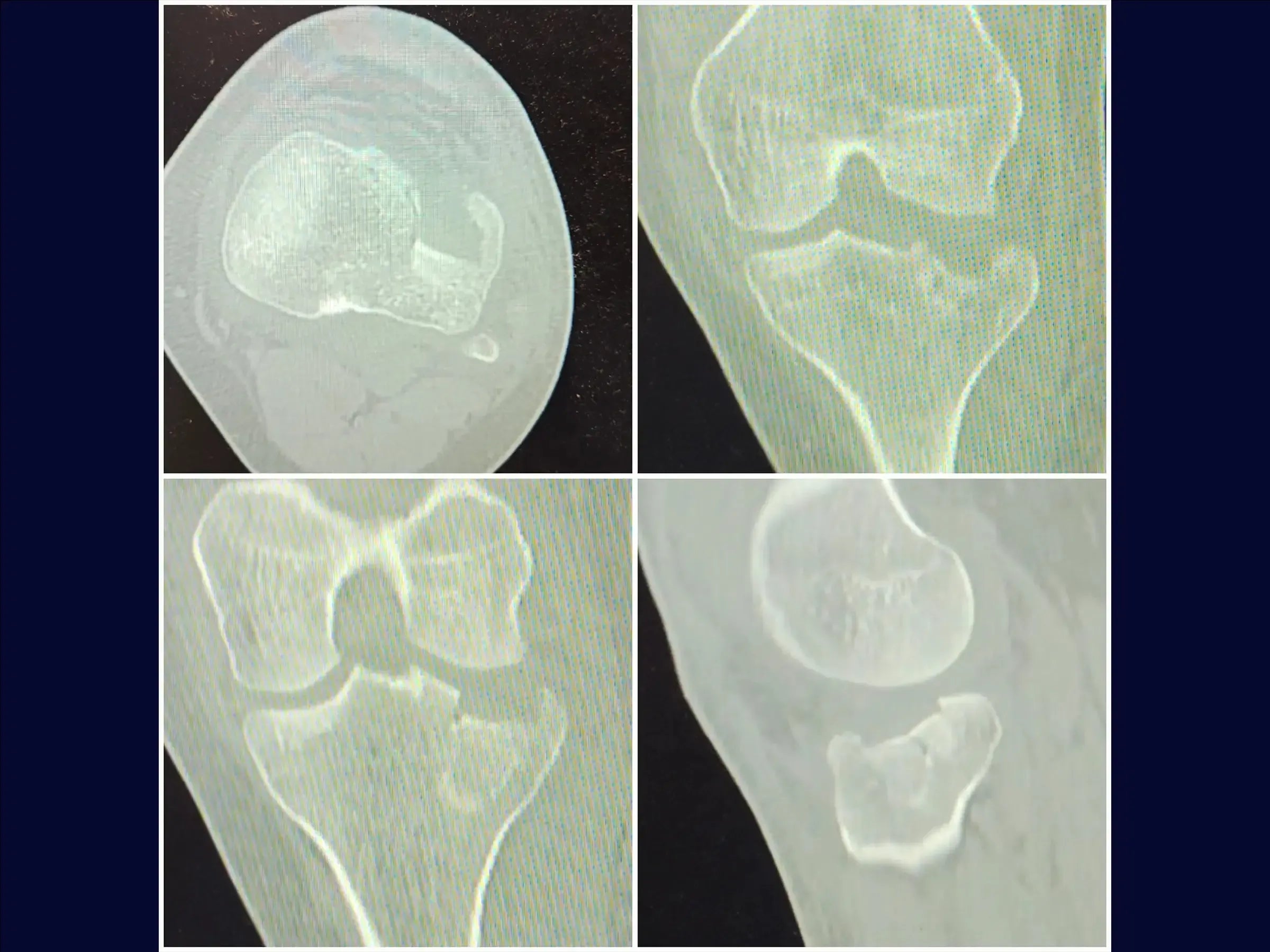Tibial Plateau Fracture with Central Depression and Incomplete Osteotomy