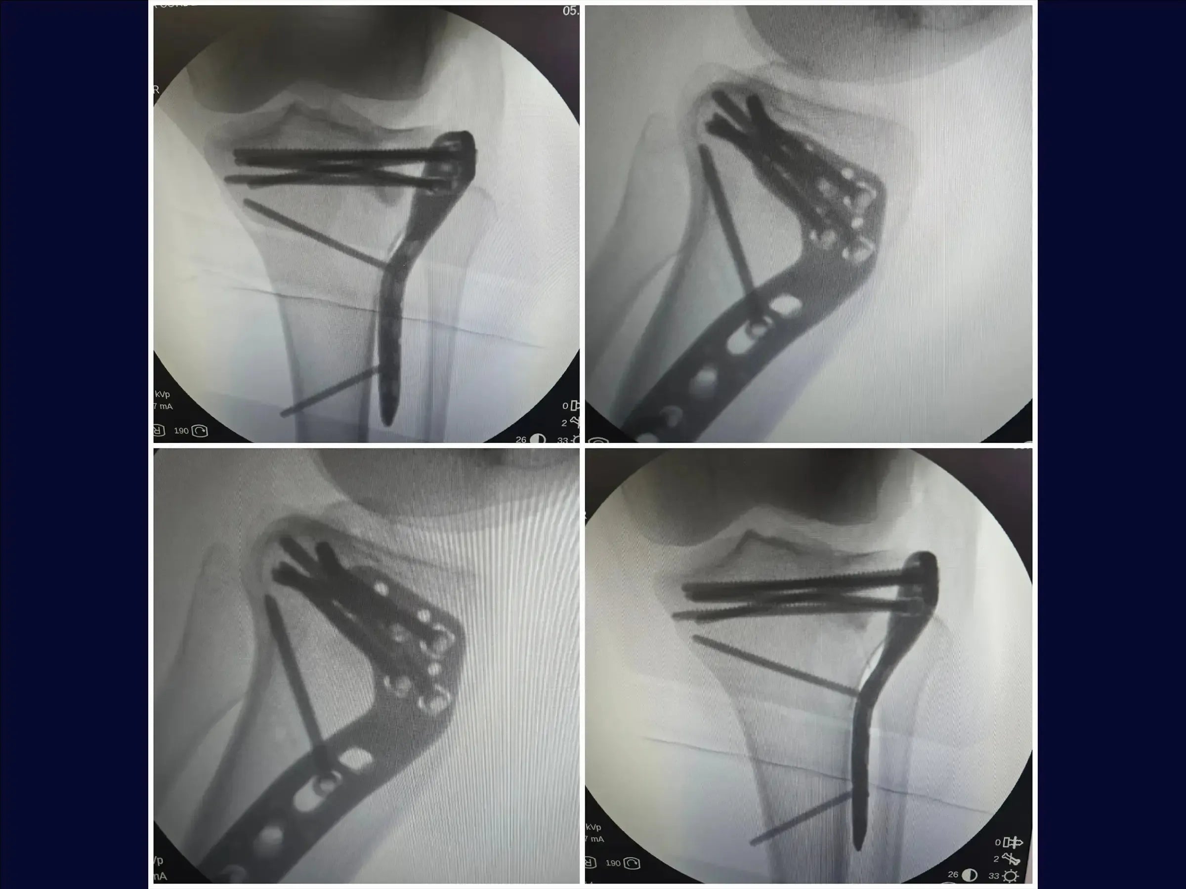 Tibial Plateau Fracture with Central Depression and Incomplete Osteotomy