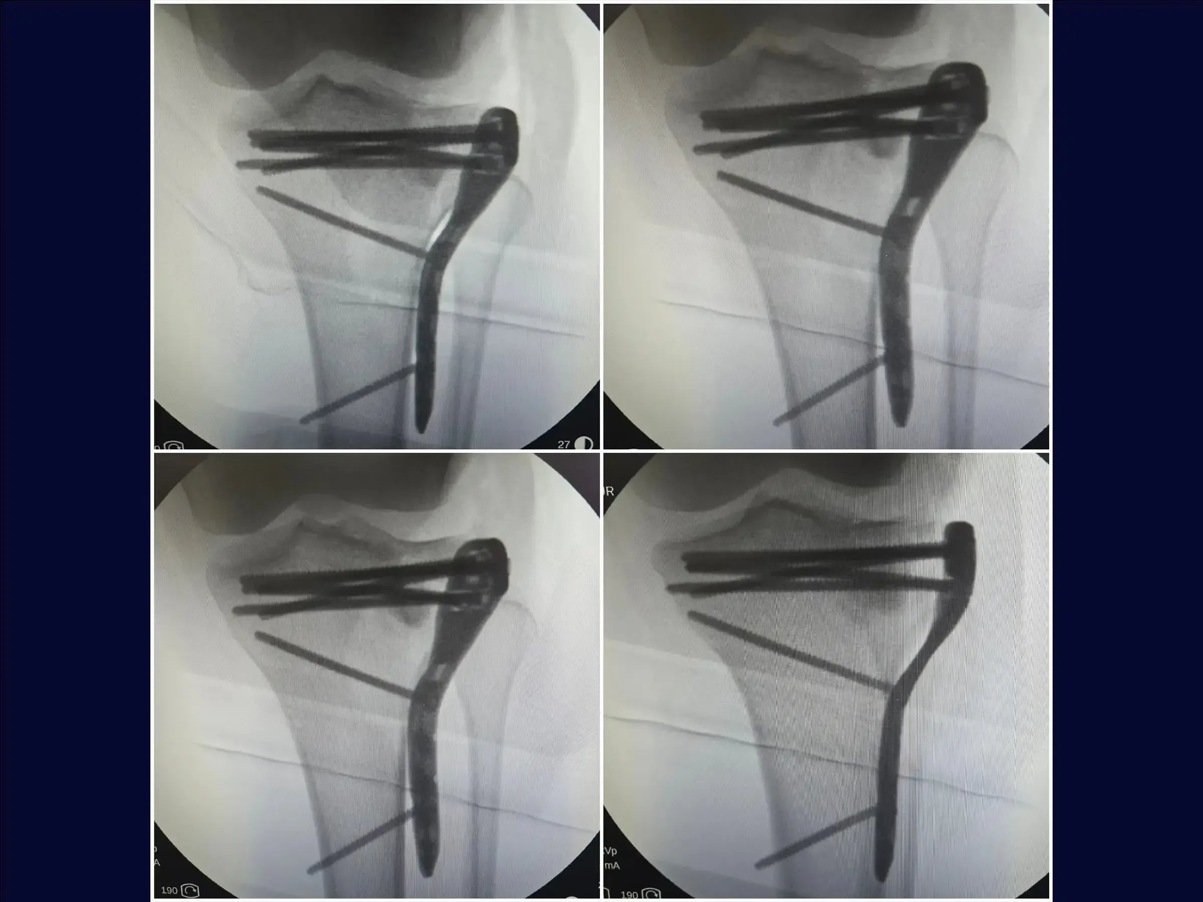Tibial Plateau Fracture with Central Depression and Incomplete Osteotomy