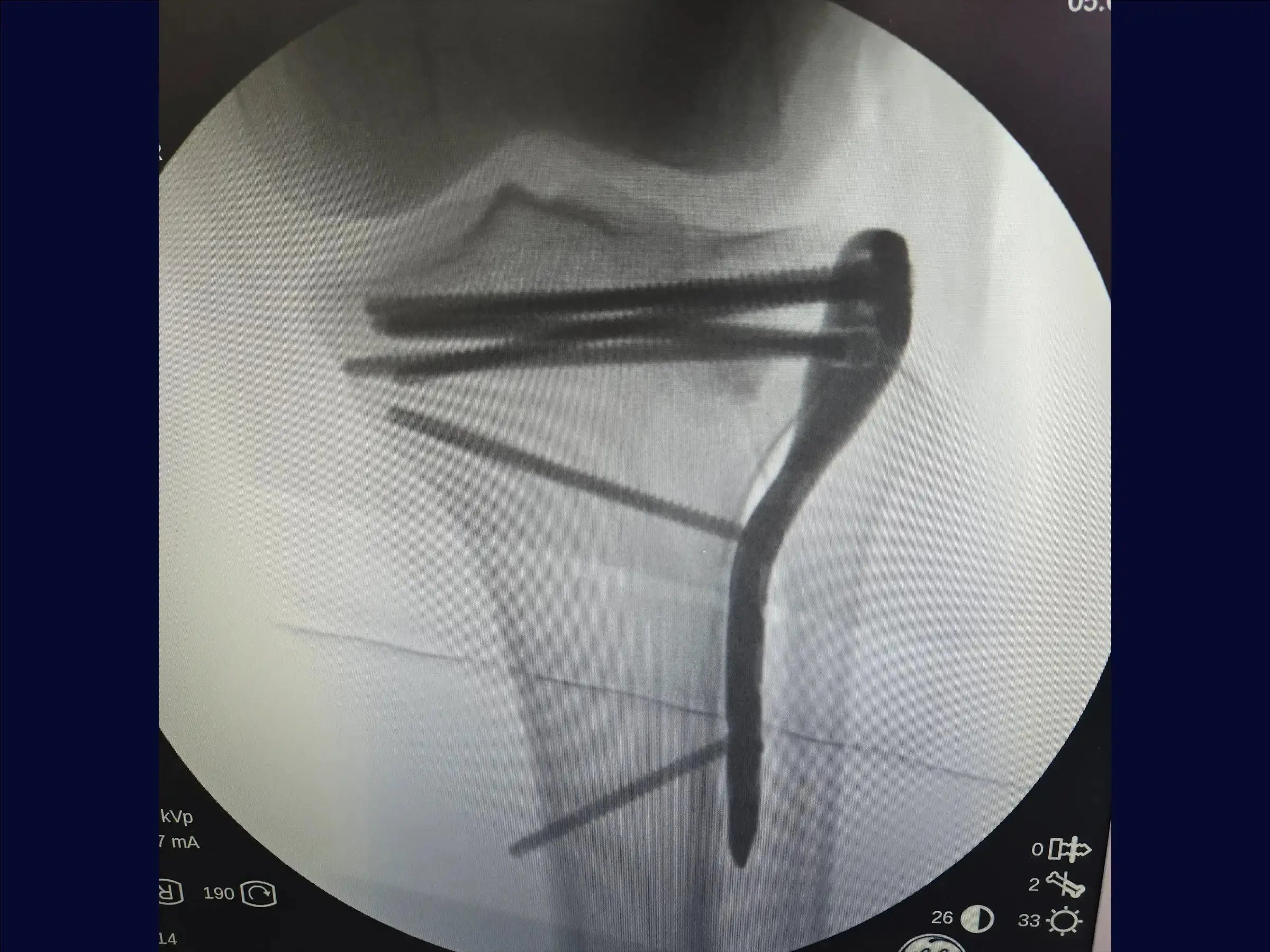 Tibial Plateau Fracture with Central Depression and Incomplete Osteotomy