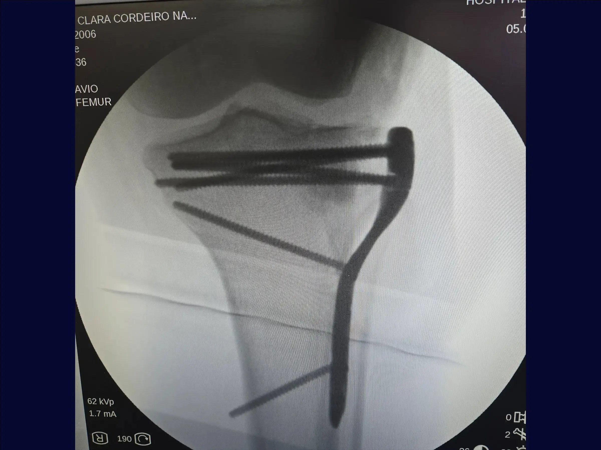 Tibial Plateau Fracture with Central Depression and Incomplete Osteotomy