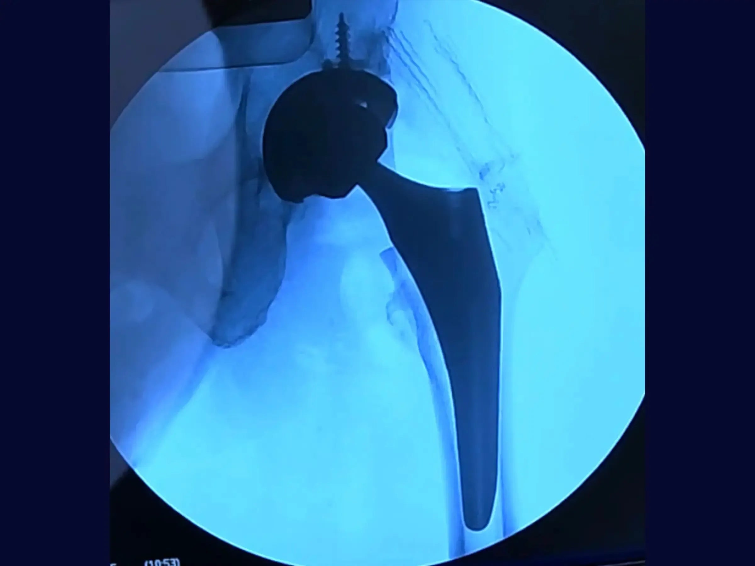 Total Hip Arthroplasty (THA) for Femoral Neck Fracture (Posterior Approach)