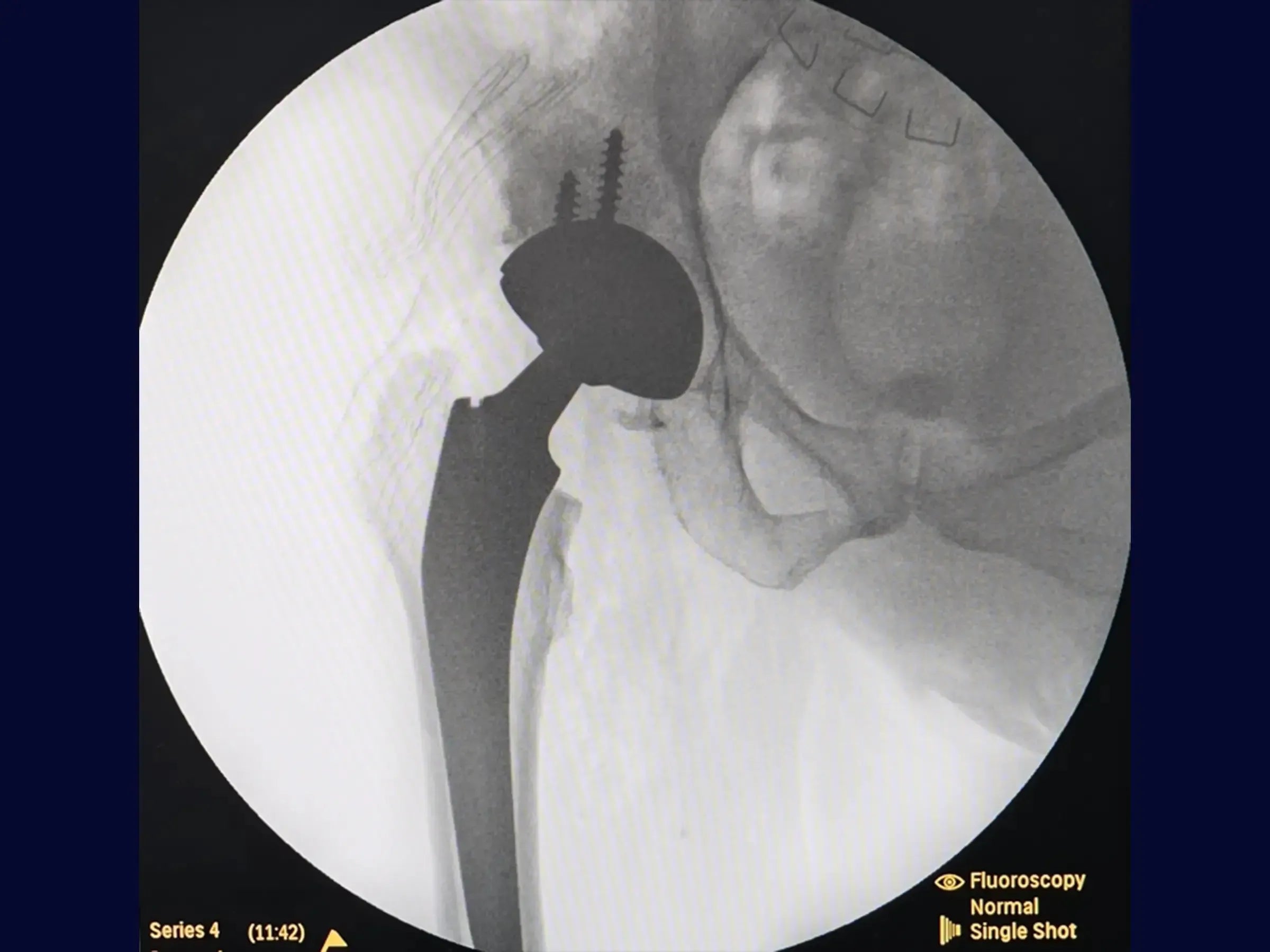 Total Hip Arthroplasty (THA) via Posterior Approach for Coxarthrosis
