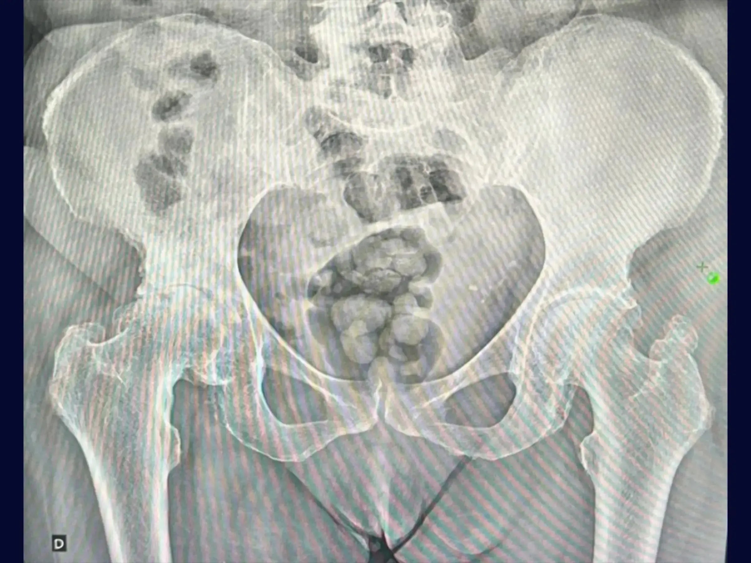 Total Hip Arthroplasty (THA) via Posterior Approach for Coxarthrosis