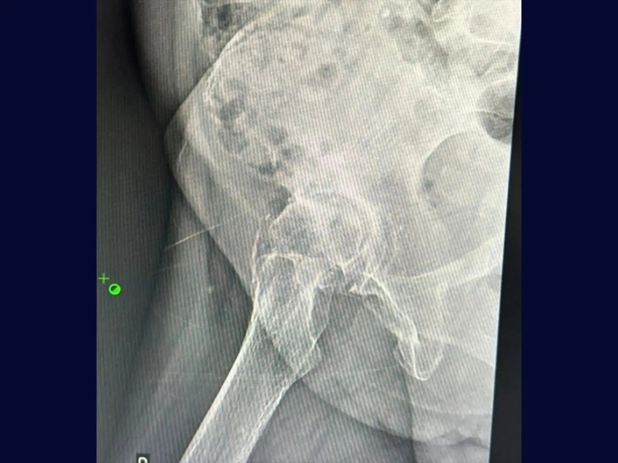 Total Hip Arthroplasty (THA) via Posterior Approach for Coxarthrosis