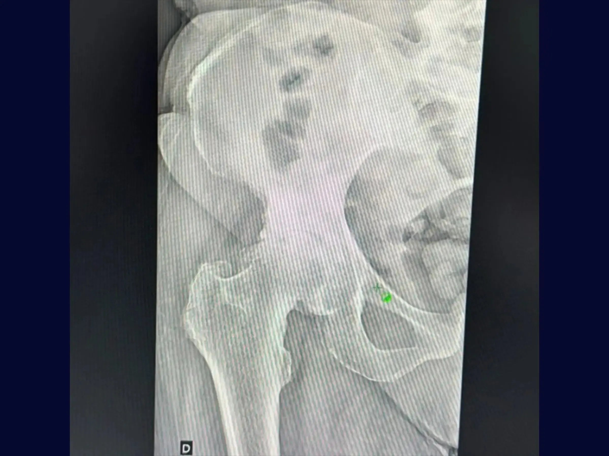 Total Hip Arthroplasty (THA) via Posterior Approach for Coxarthrosis