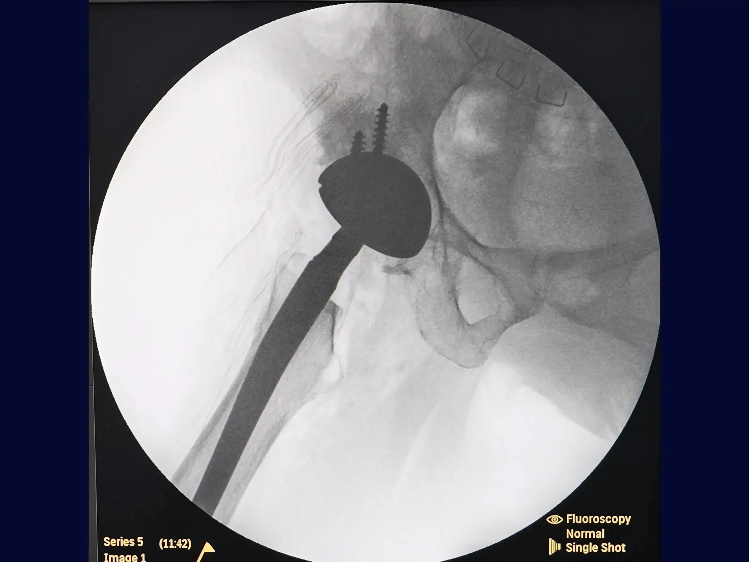 Total Hip Arthroplasty (THA) via Posterior Approach for Coxarthrosis