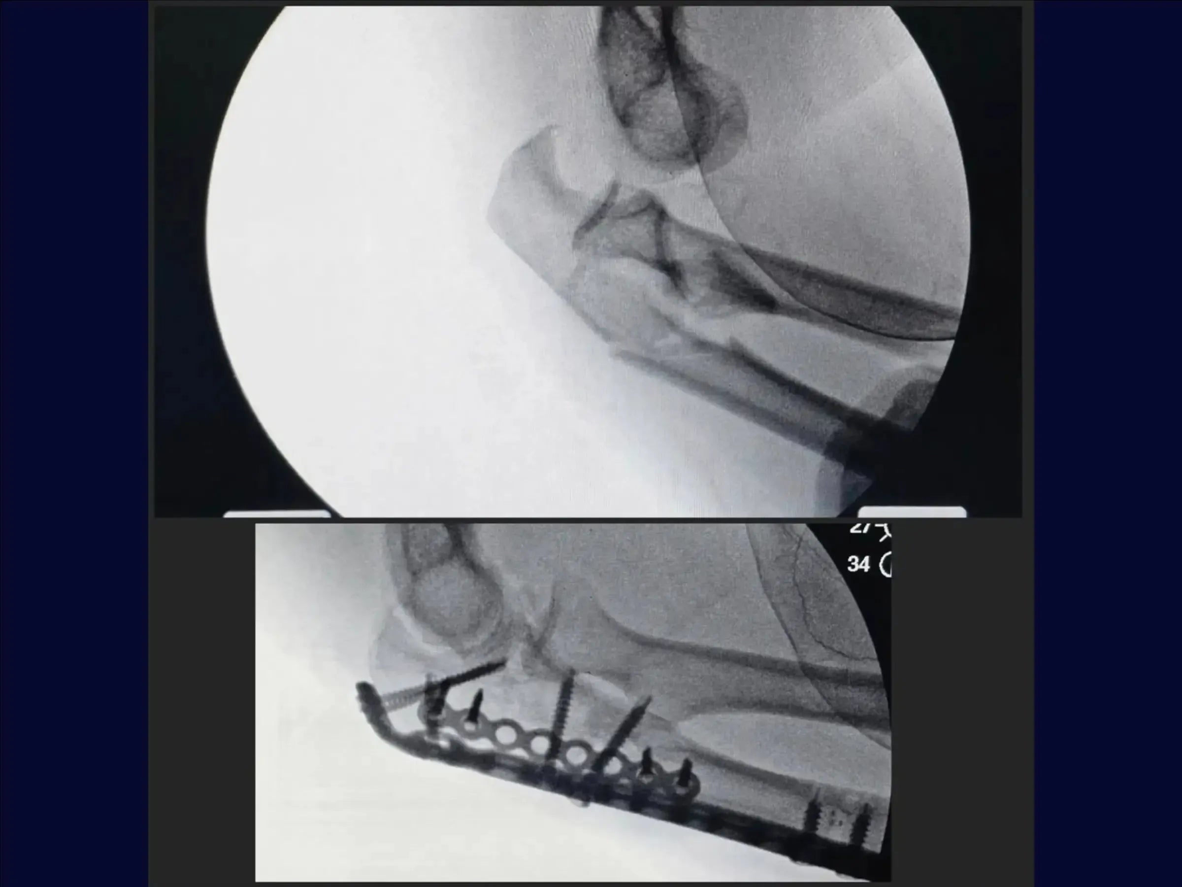 Transolecranon Fracture-Dislocation of the Elbow (Monteggia Variant) – "Pull-out" Technique