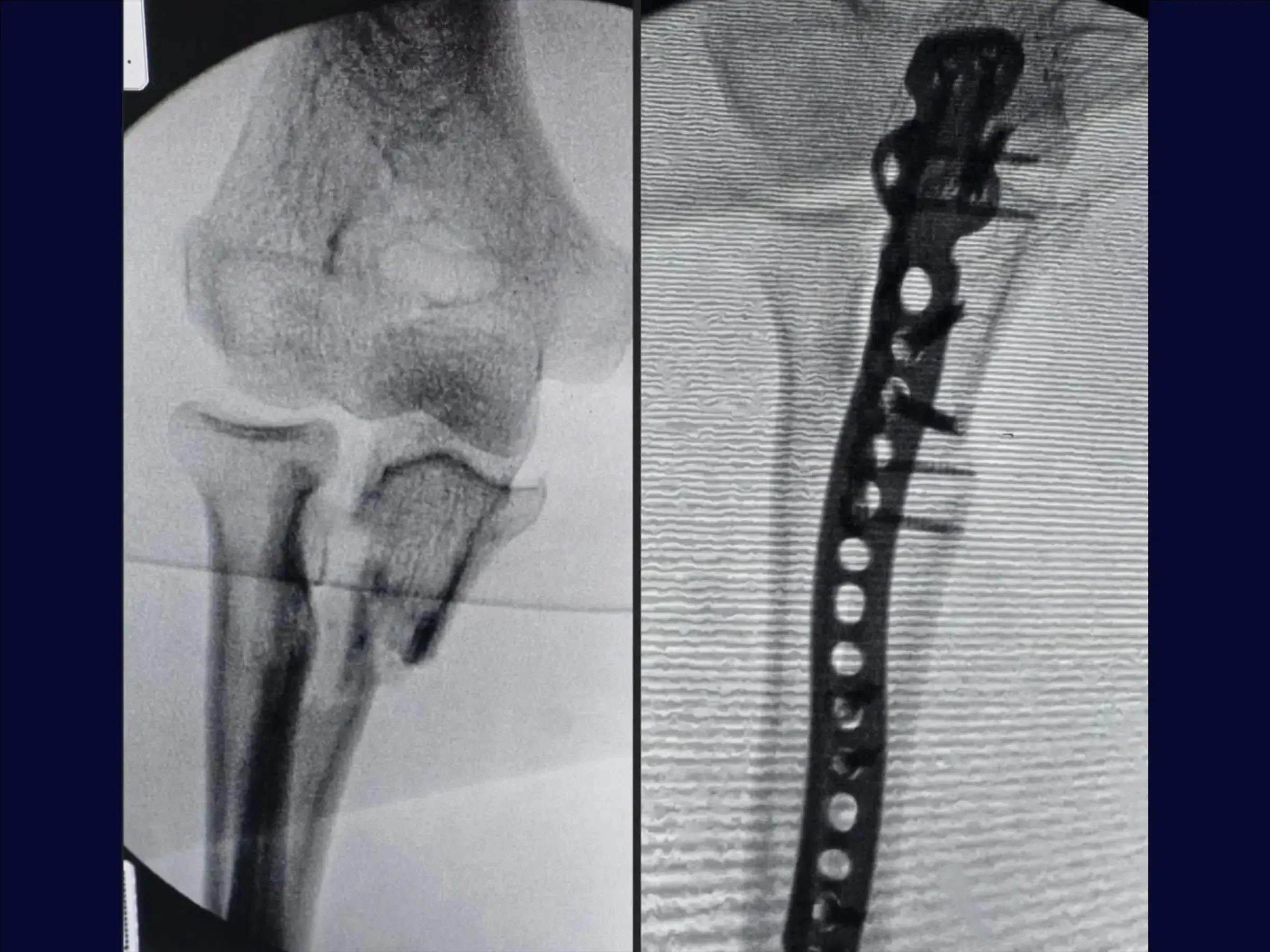 Transolecranon Fracture-Dislocation of the Elbow (Monteggia Variant) – "Pull-out" Technique