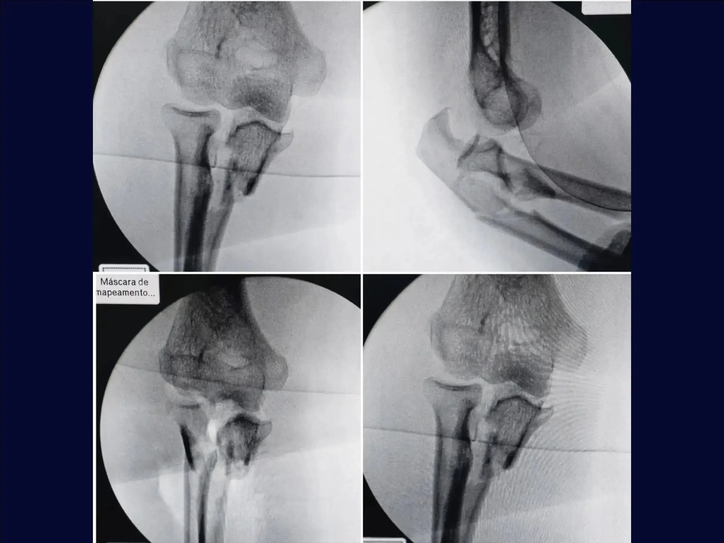 Transolecranon Fracture-Dislocation of the Elbow (Monteggia Variant) – "Pull-out" Technique