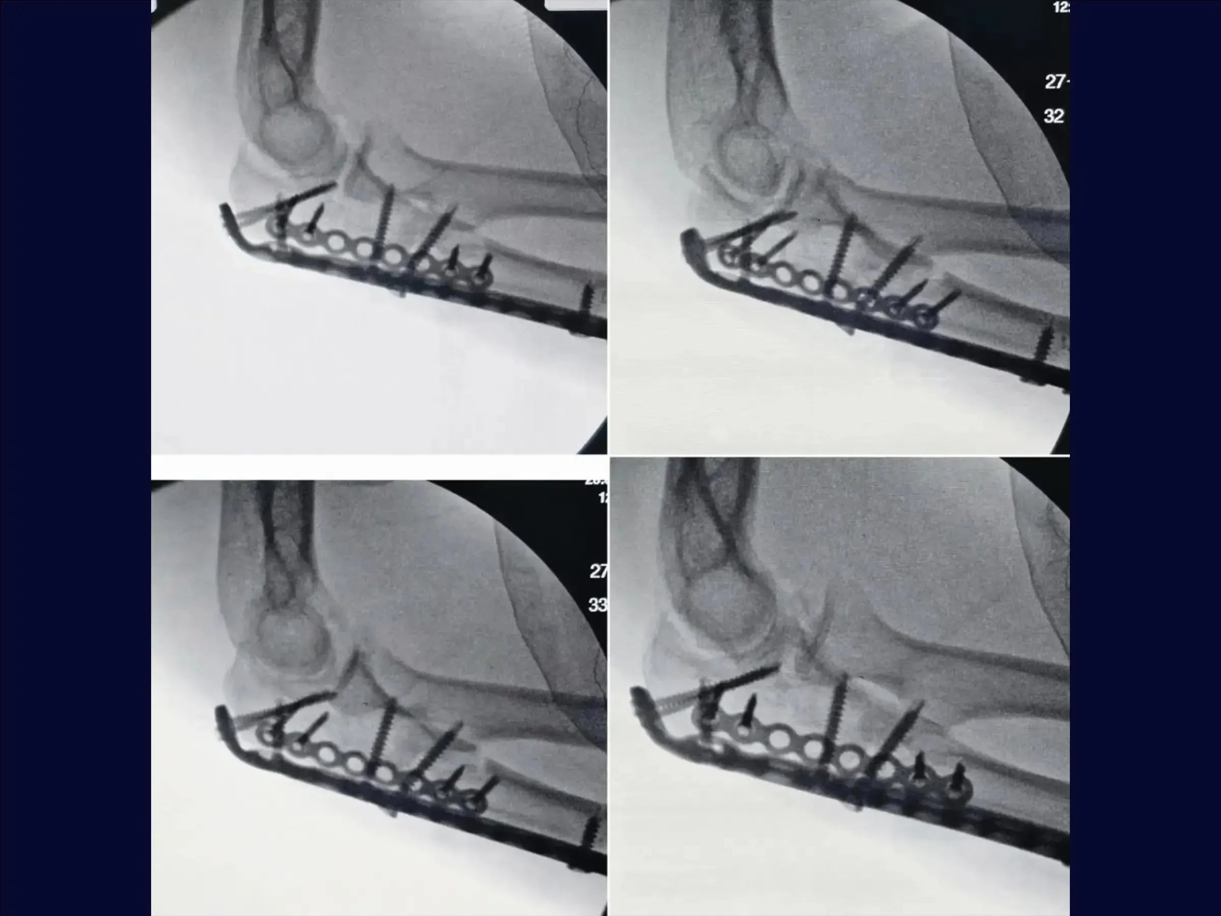 Transolecranon Fracture-Dislocation of the Elbow (Monteggia Variant) – "Pull-out" Technique