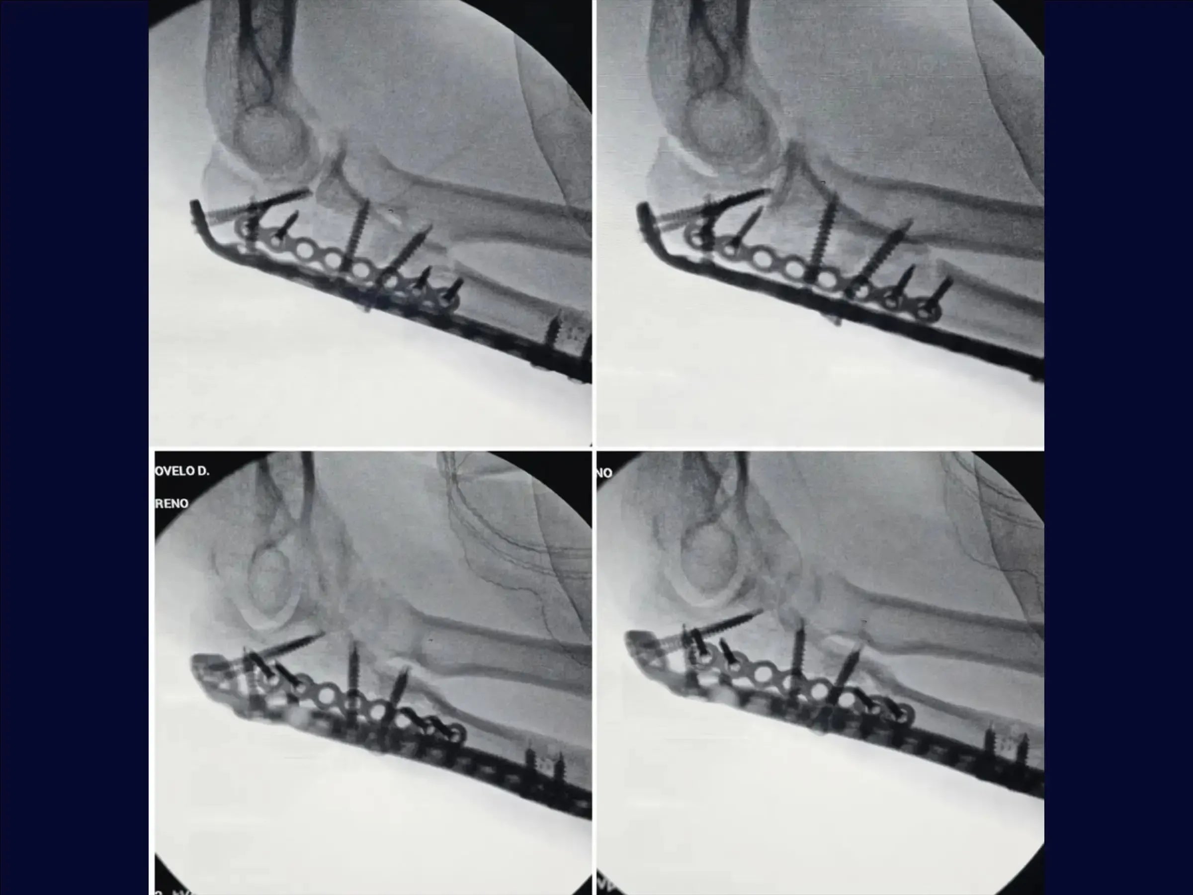 Transolecranon Fracture-Dislocation of the Elbow (Monteggia Variant) – "Pull-out" Technique