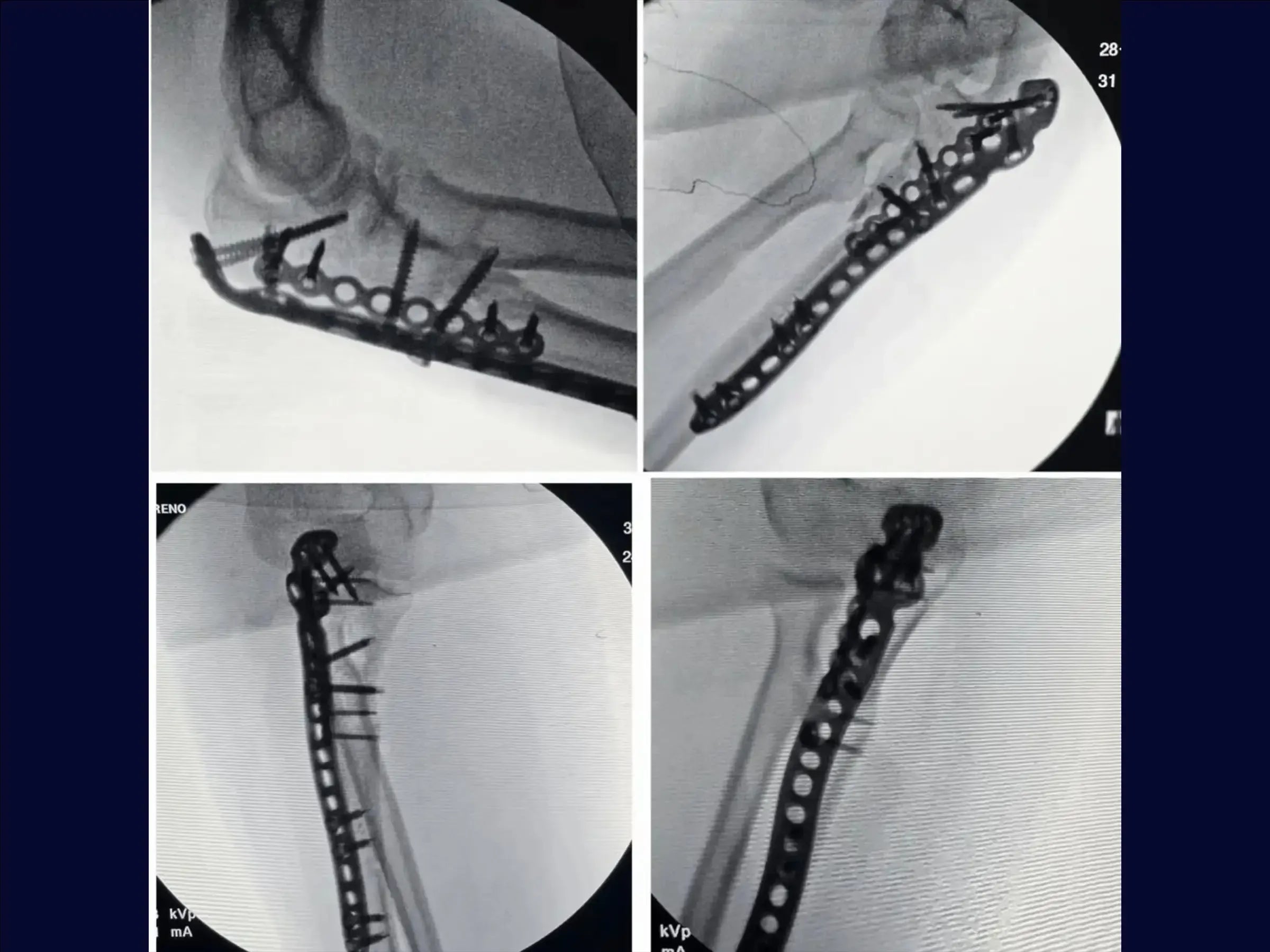 Transolecranon Fracture-Dislocation of the Elbow (Monteggia Variant) – "Pull-out" Technique