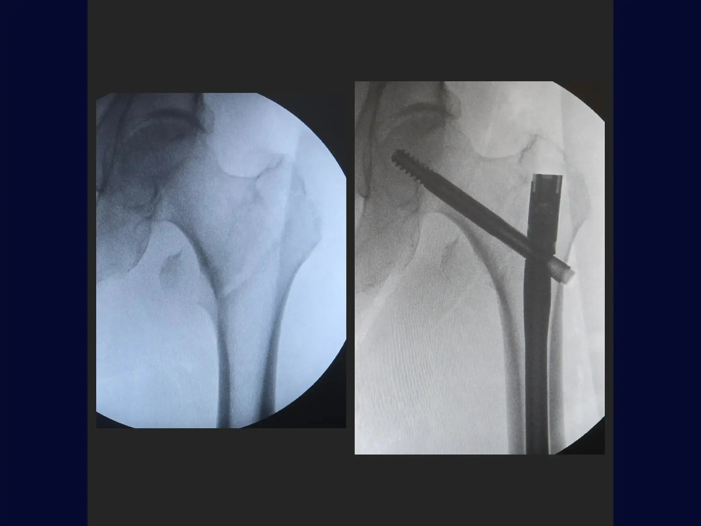 Transtrochanteric Fracture with Intramedullary Nail (Without Traction Table)
