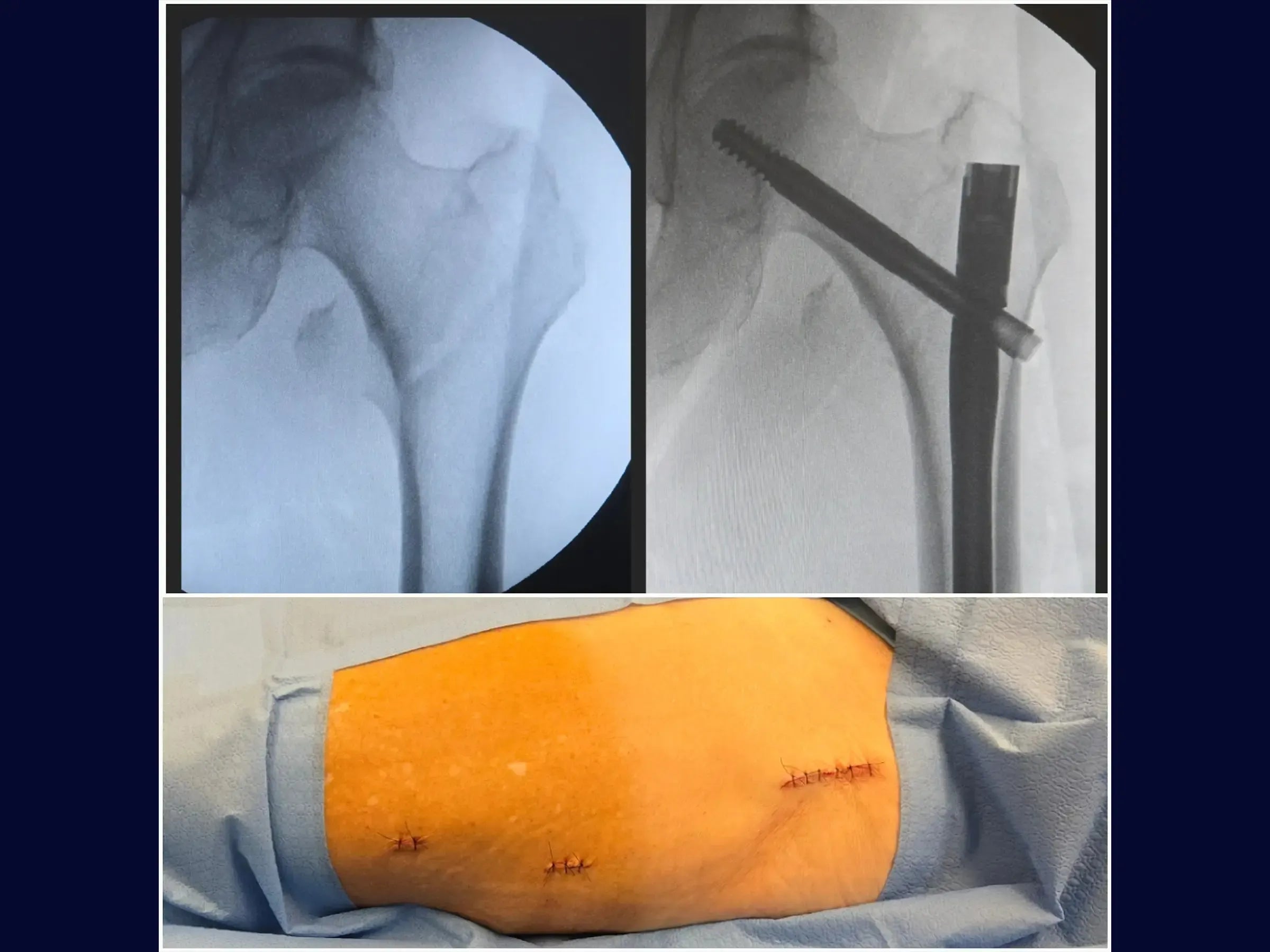 Transtrochanteric Fracture with Intramedullary Nail (Without Traction Table)