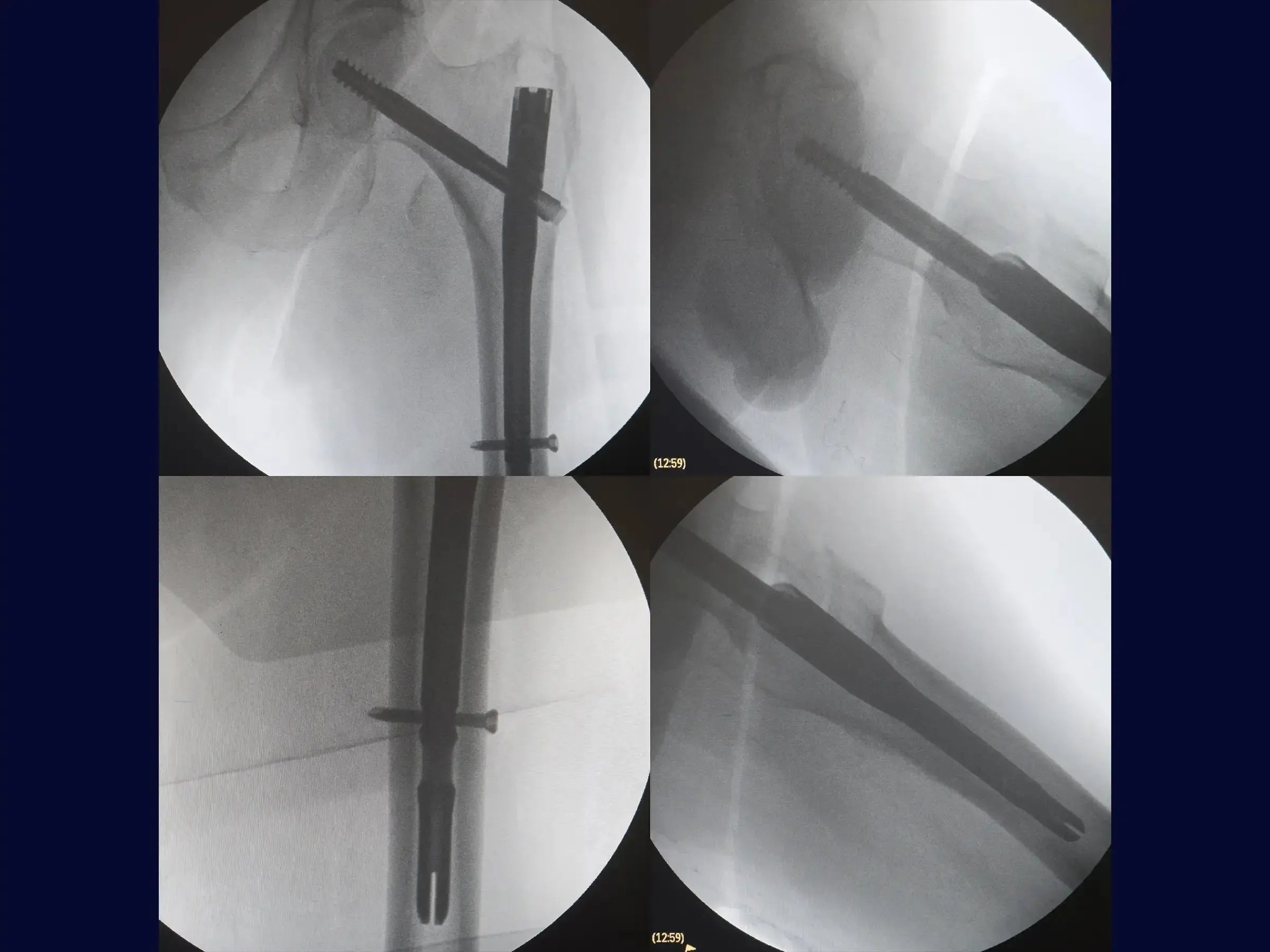 Transtrochanteric Fracture with Intramedullary Nail (Without Traction Table)
