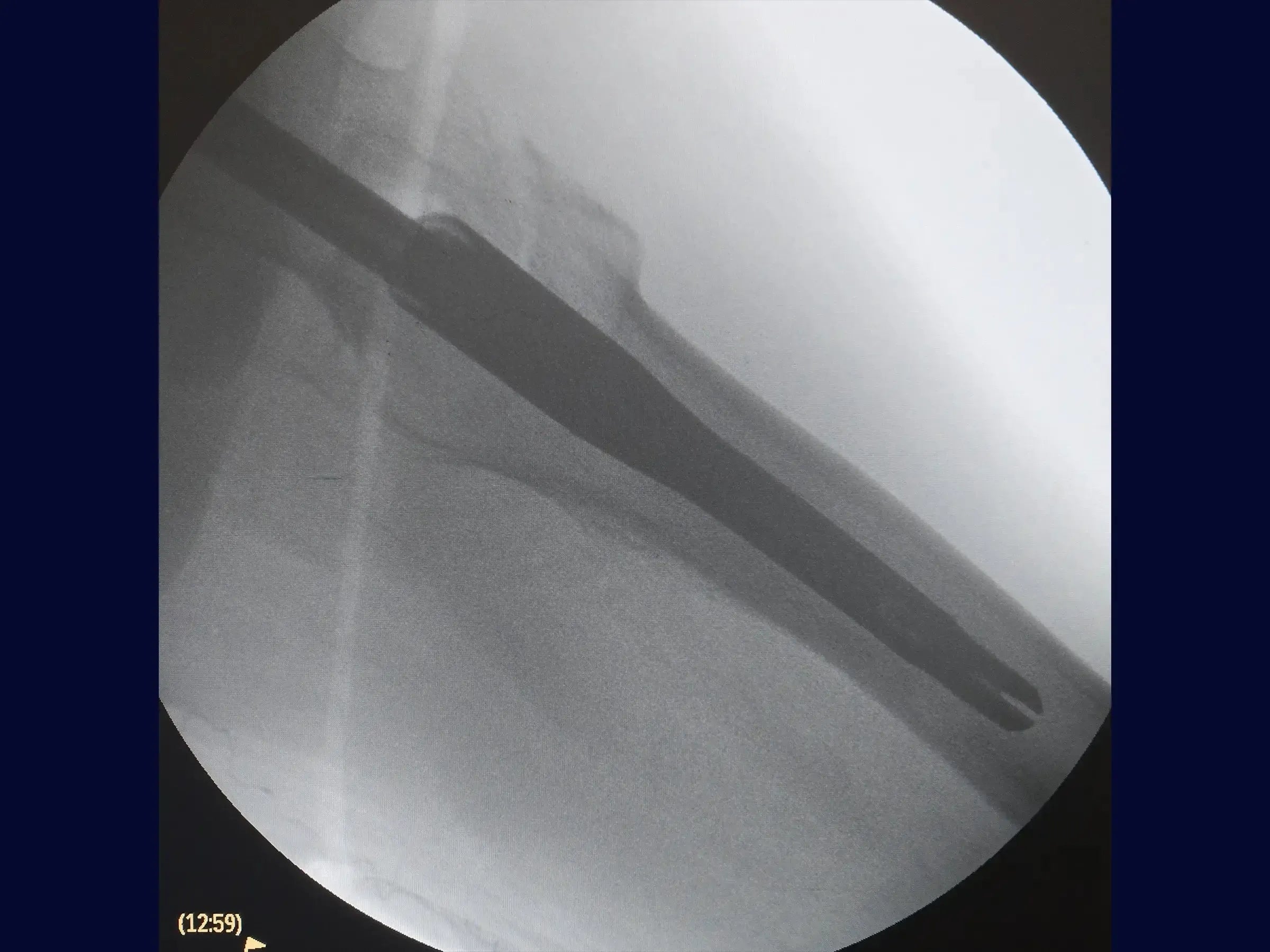 Transtrochanteric Fracture with Intramedullary Nail (Without Traction Table)