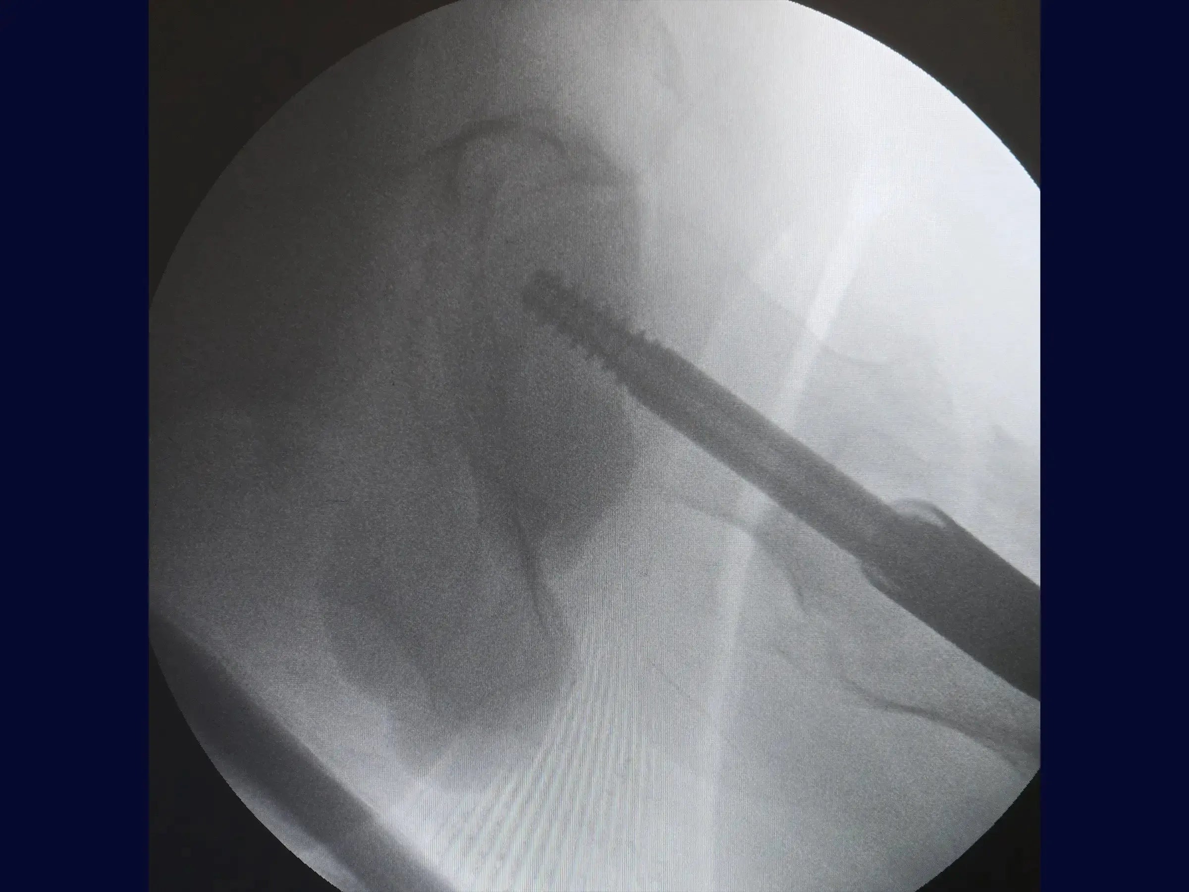 Transtrochanteric Fracture with Intramedullary Nail (Without Traction Table)