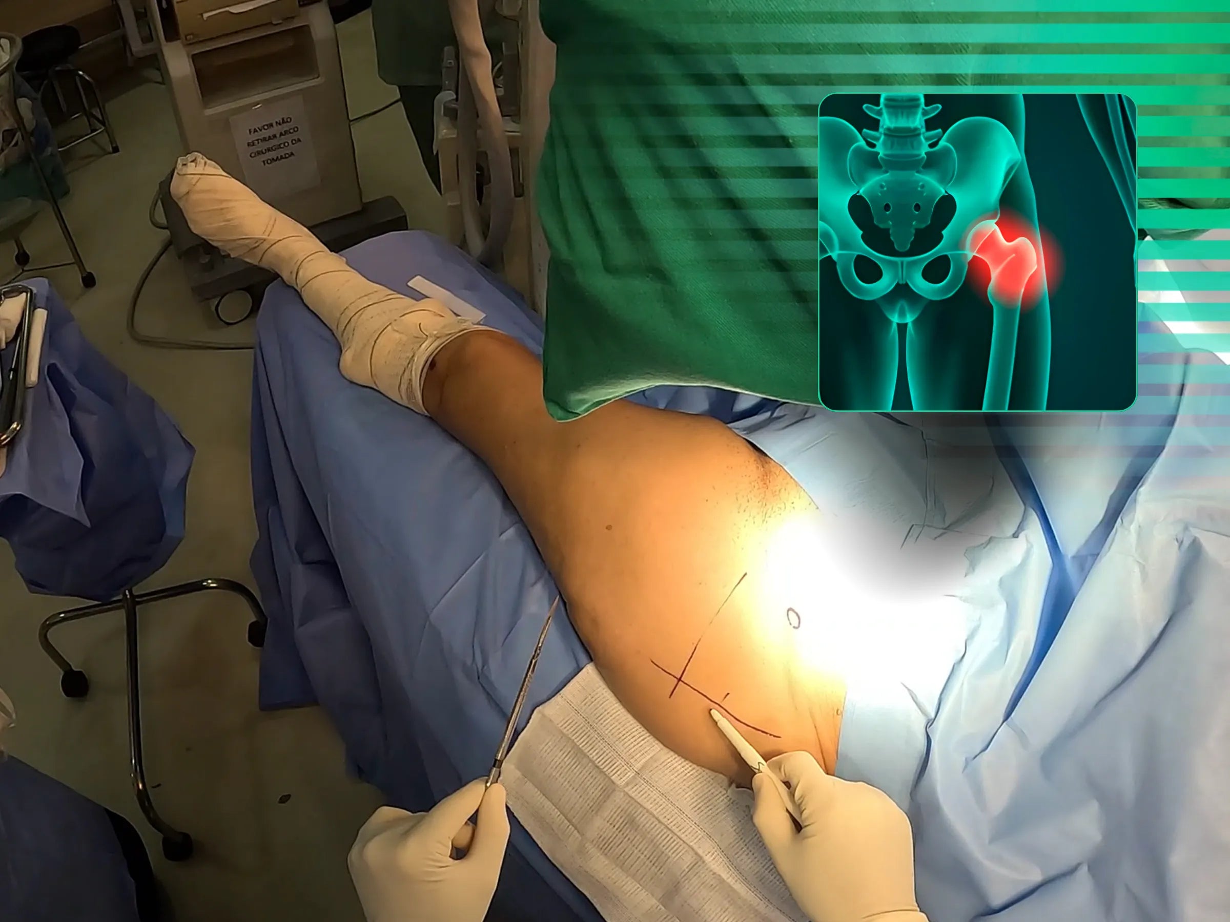 Fratura Transtrocanteriana com Haste Intramedular (Sem Mesa de Tração)