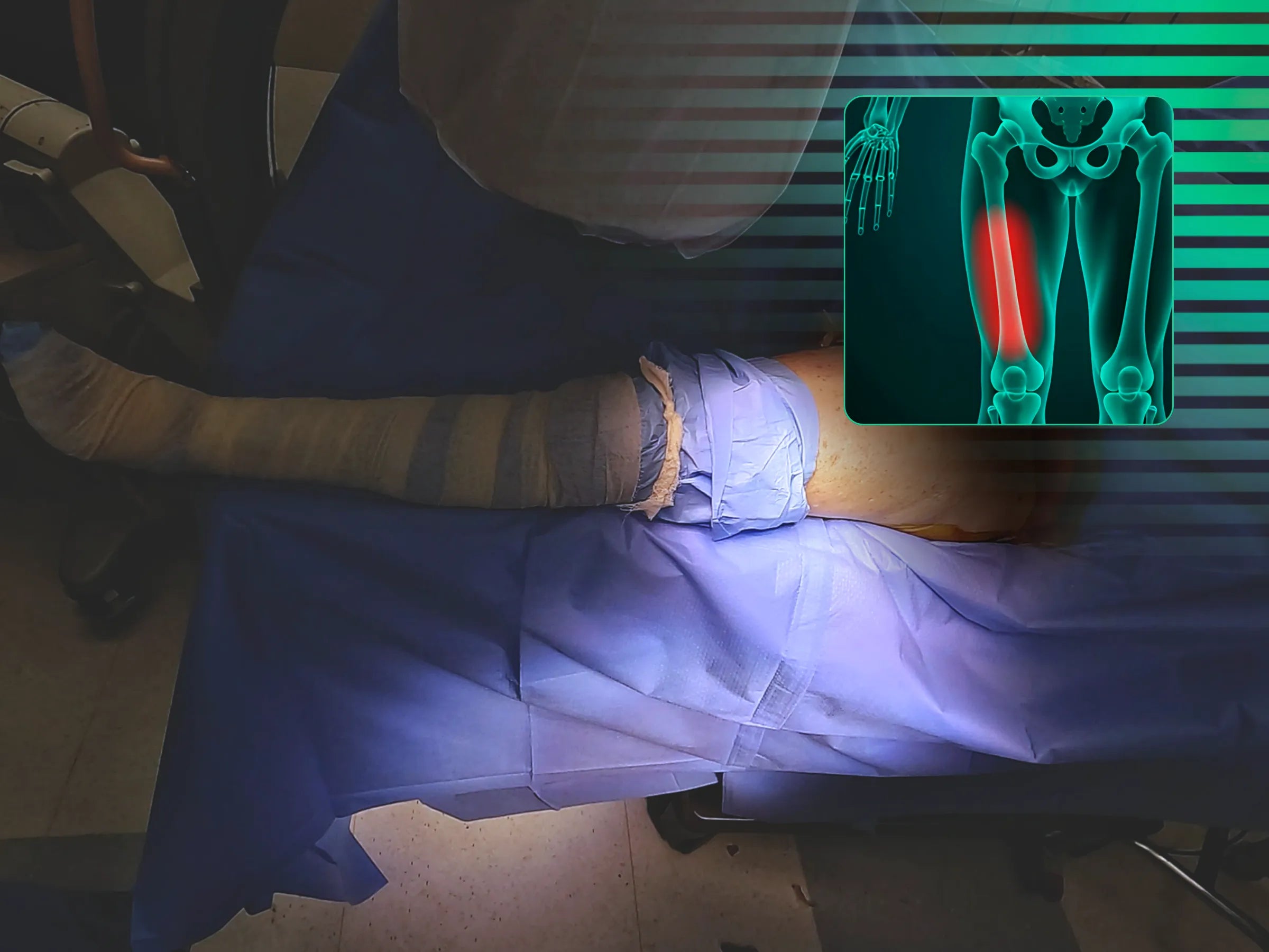 Tratamiento de la fractura de fémur proximal con enclavado intramedular y maniobra de balancín