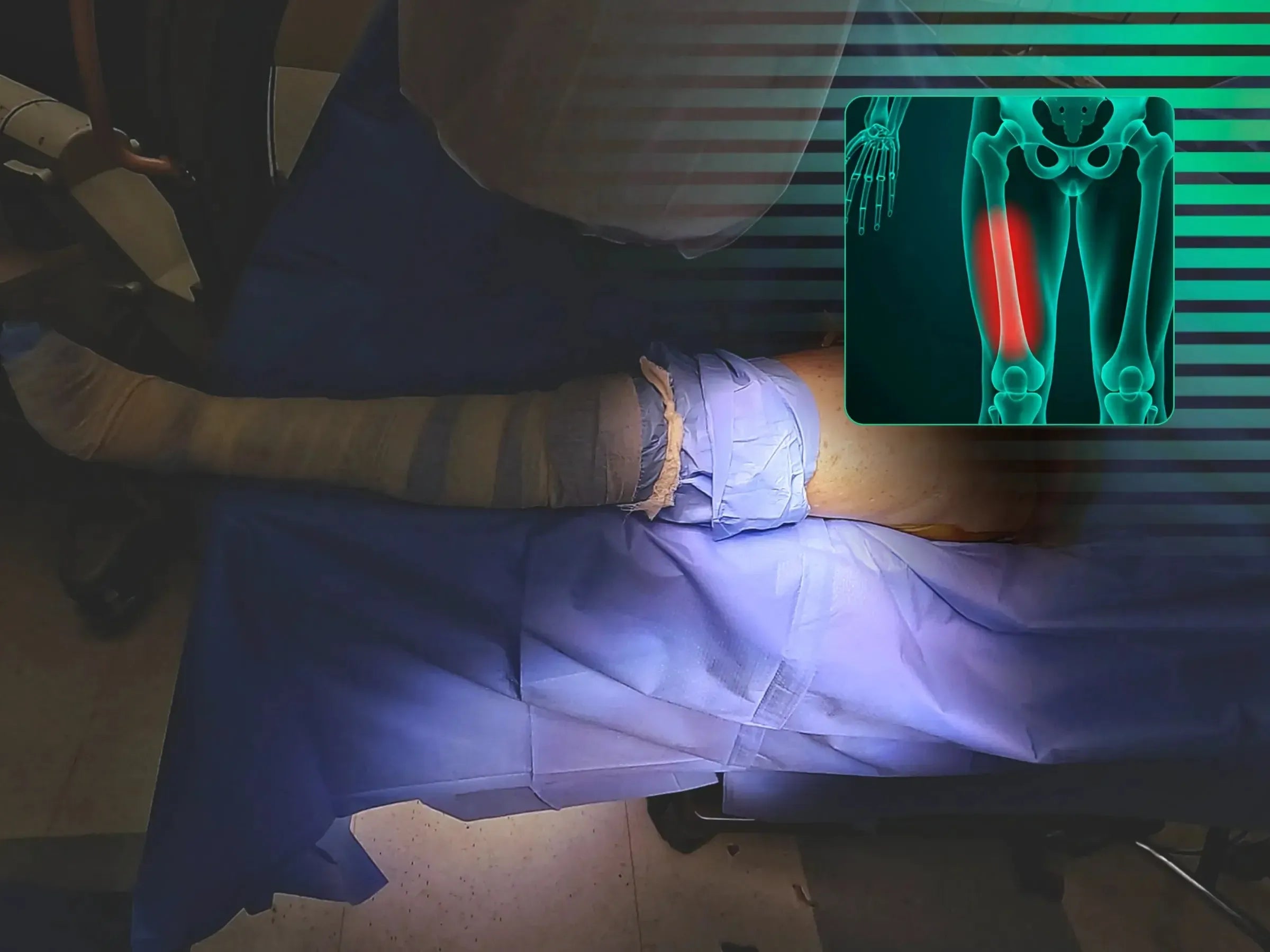 Treatment of Proximal Femur Fracture with Intramedullary Nail and See-Saw Maneuver