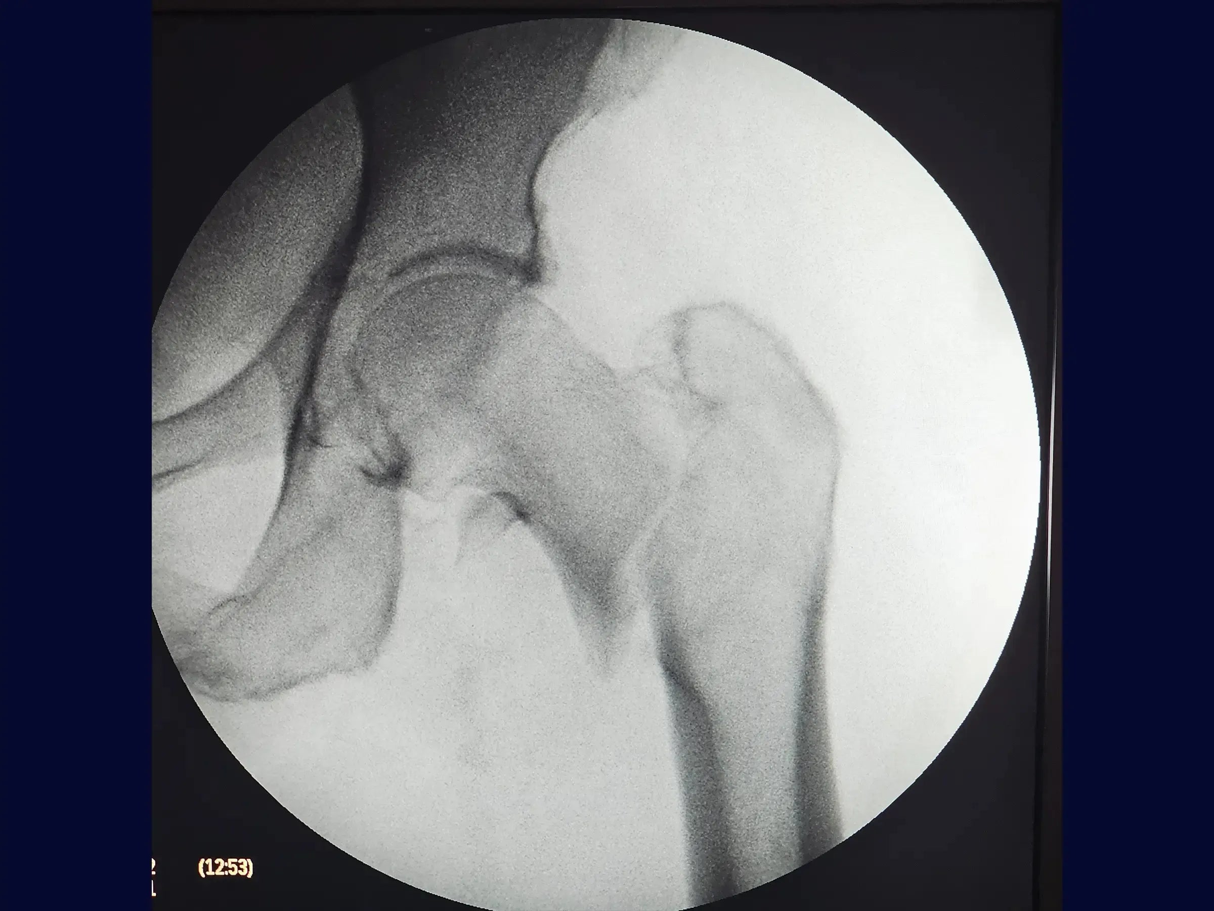Treatment of Proximal Femur Fracture with Intramedullary Nail and See-Saw Maneuver