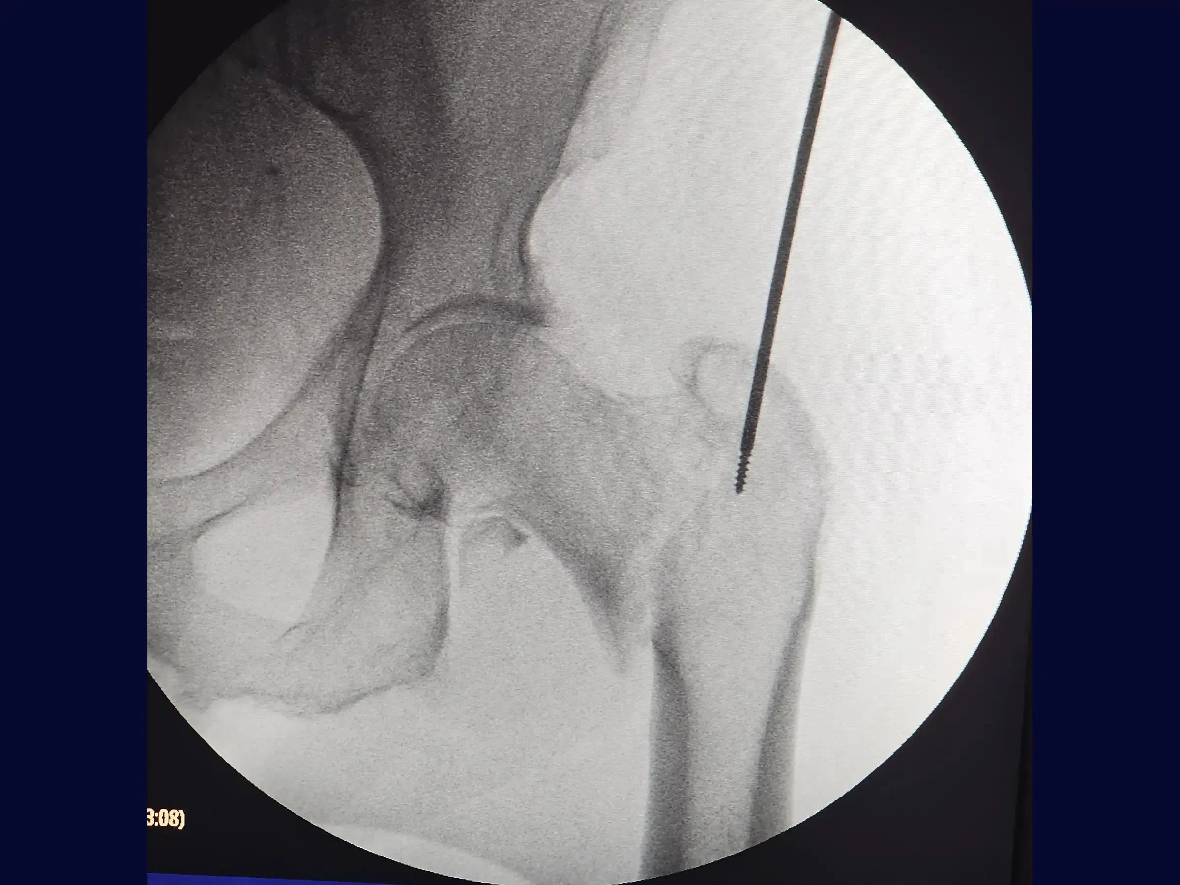 Treatment of Proximal Femur Fracture with Intramedullary Nail and See-Saw Maneuver