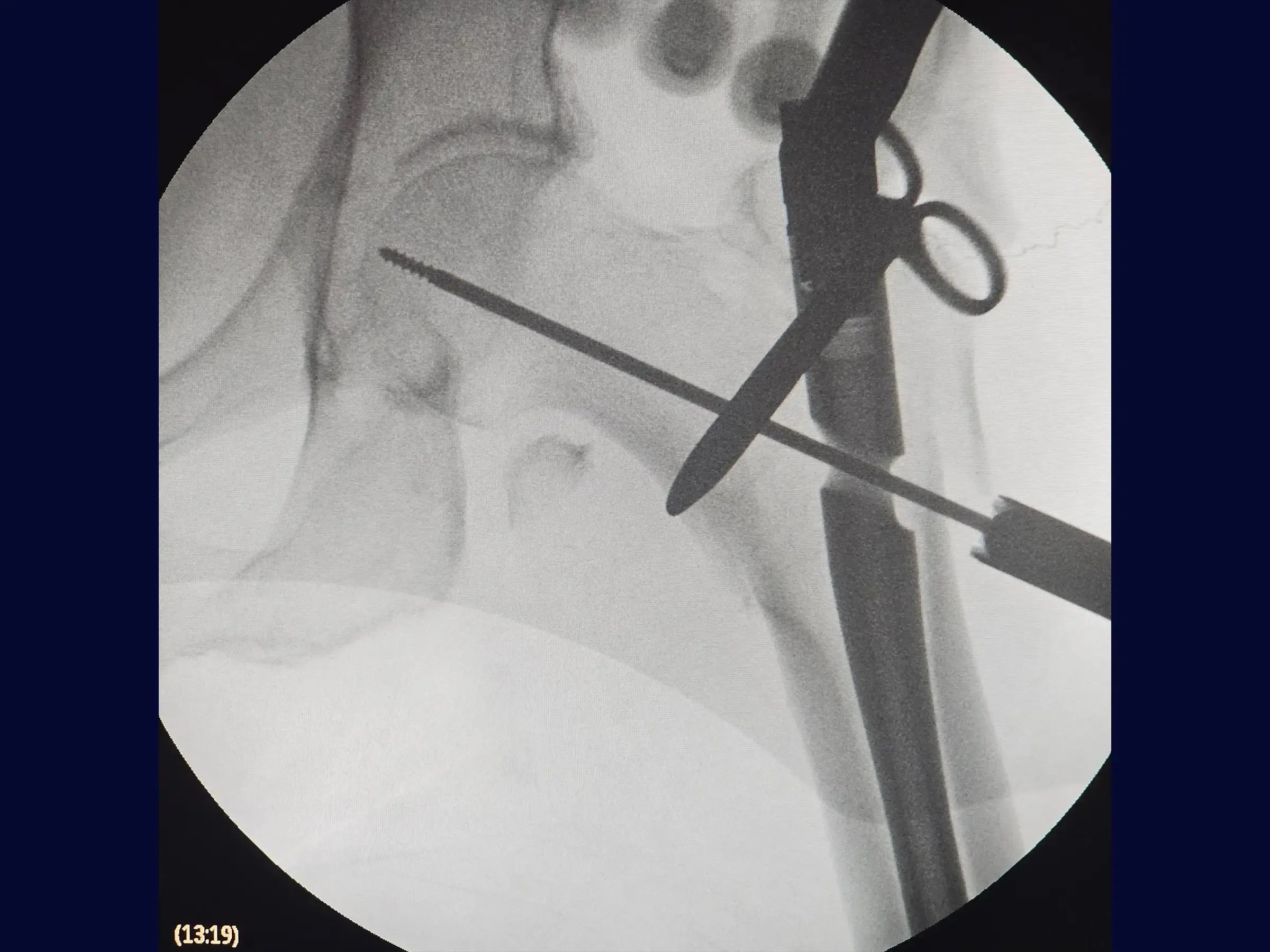 Treatment of Proximal Femur Fracture with Intramedullary Nail and See-Saw Maneuver