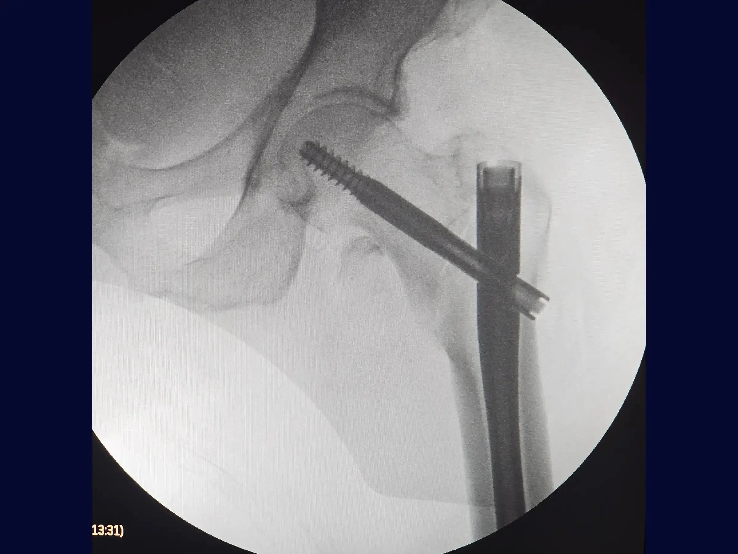 Treatment of Proximal Femur Fracture with Intramedullary Nail and See-Saw Maneuver
