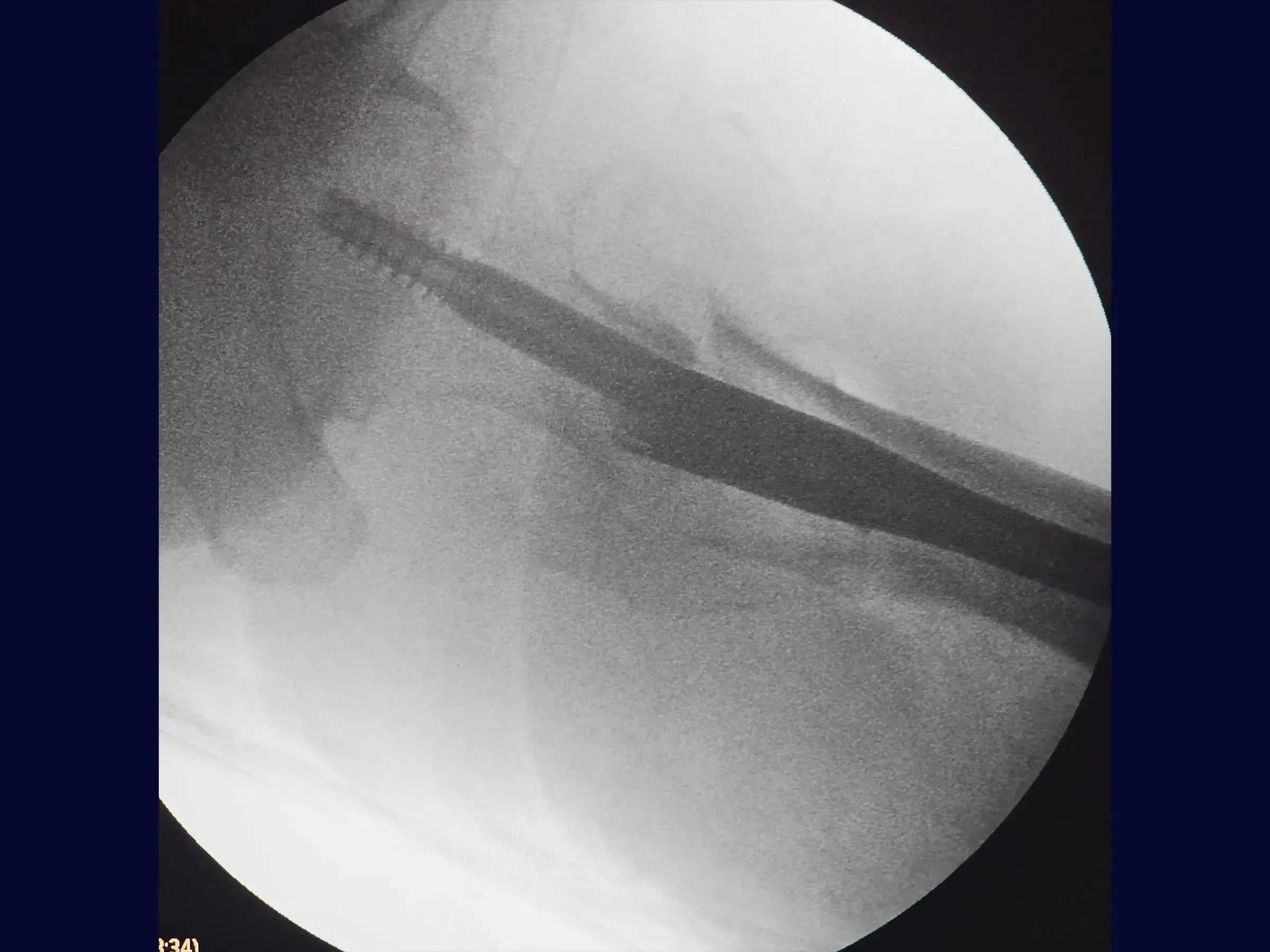 Treatment of Proximal Femur Fracture with Intramedullary Nail and See-Saw Maneuver