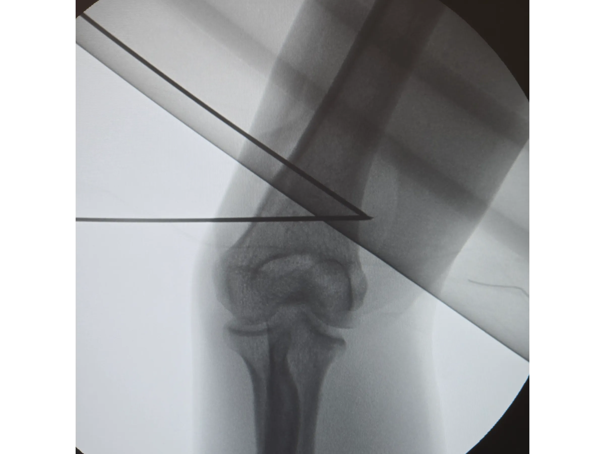 Osteotomia do Úmero Distal – Cúbito Varo