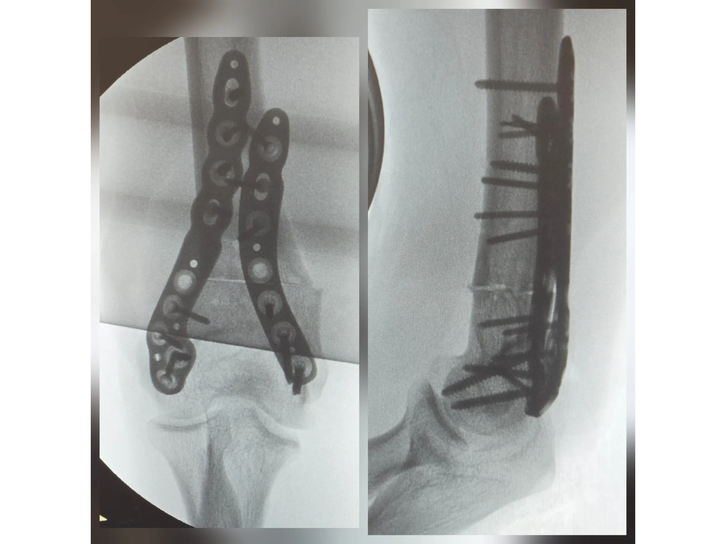 Osteotomia do Úmero Distal – Cúbito Varo